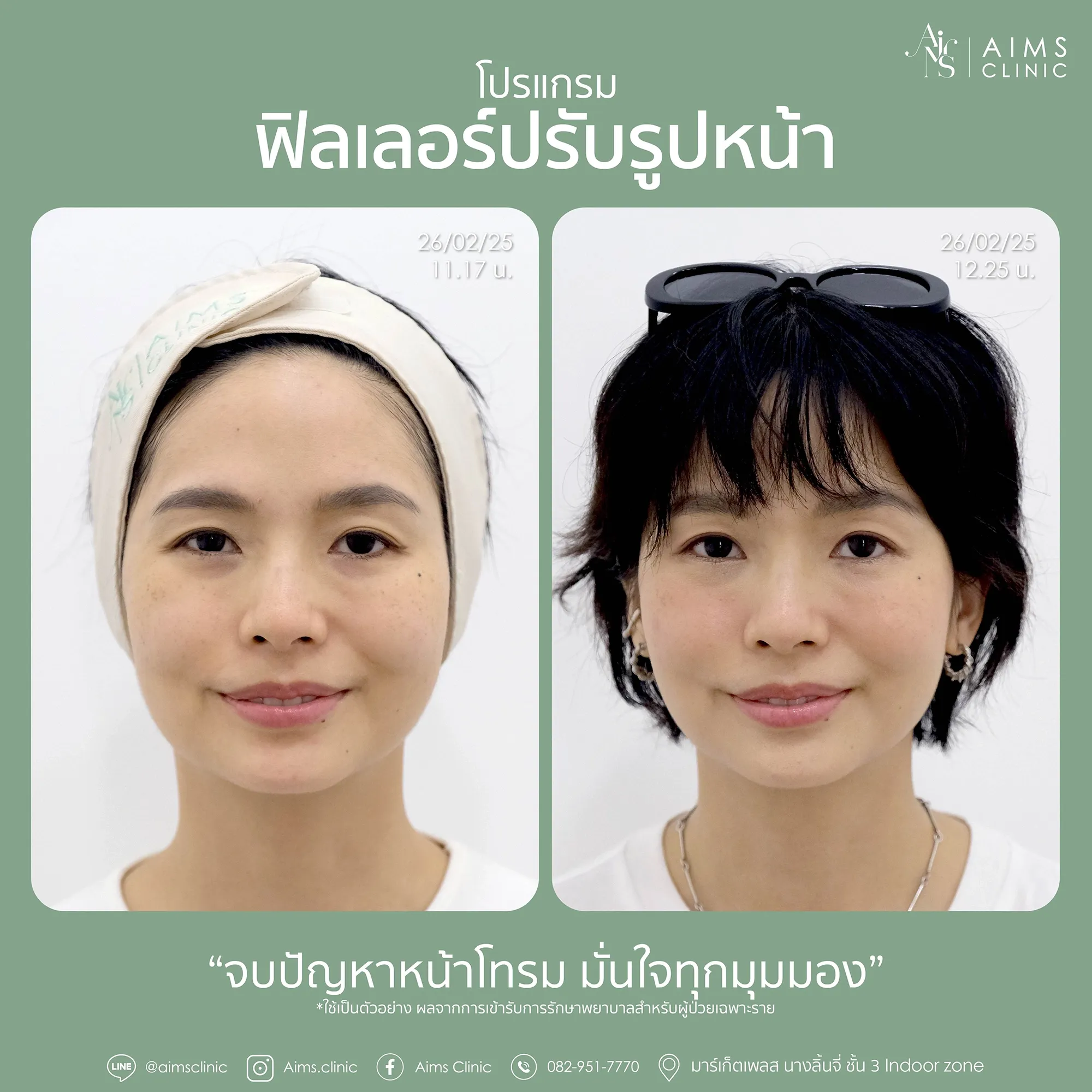 Before_After_Filler-1-02.webp