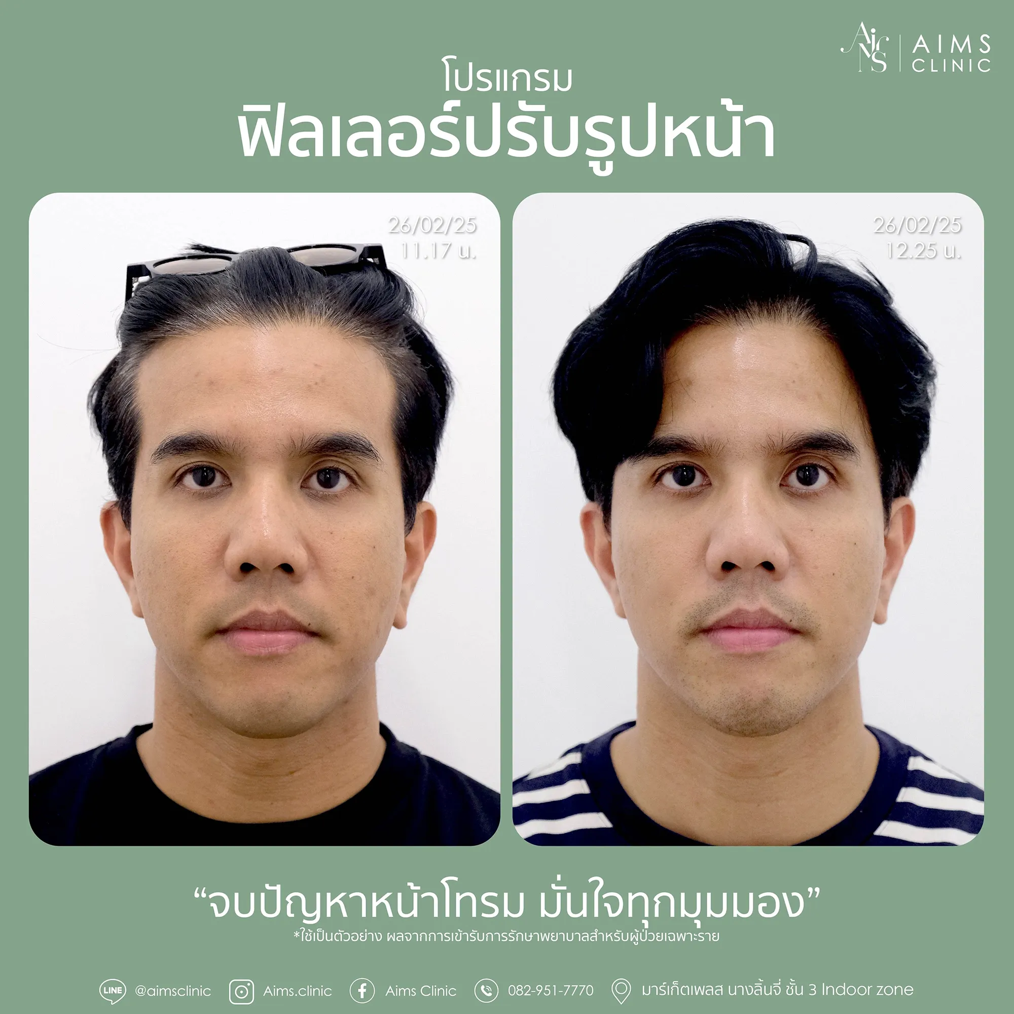 Before_After_Filler-1-03.webp
