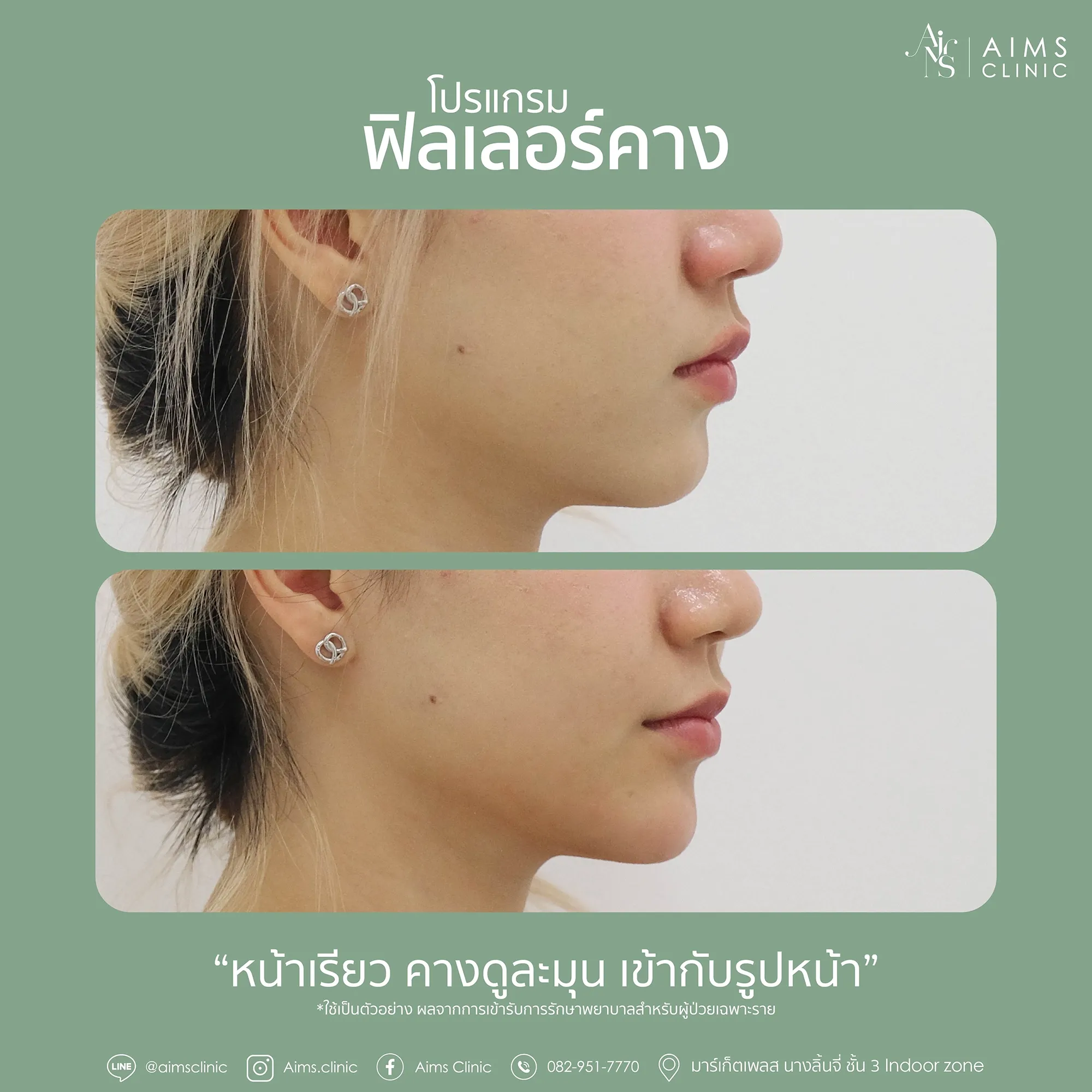 Before_After_Filler-1-04.webp
