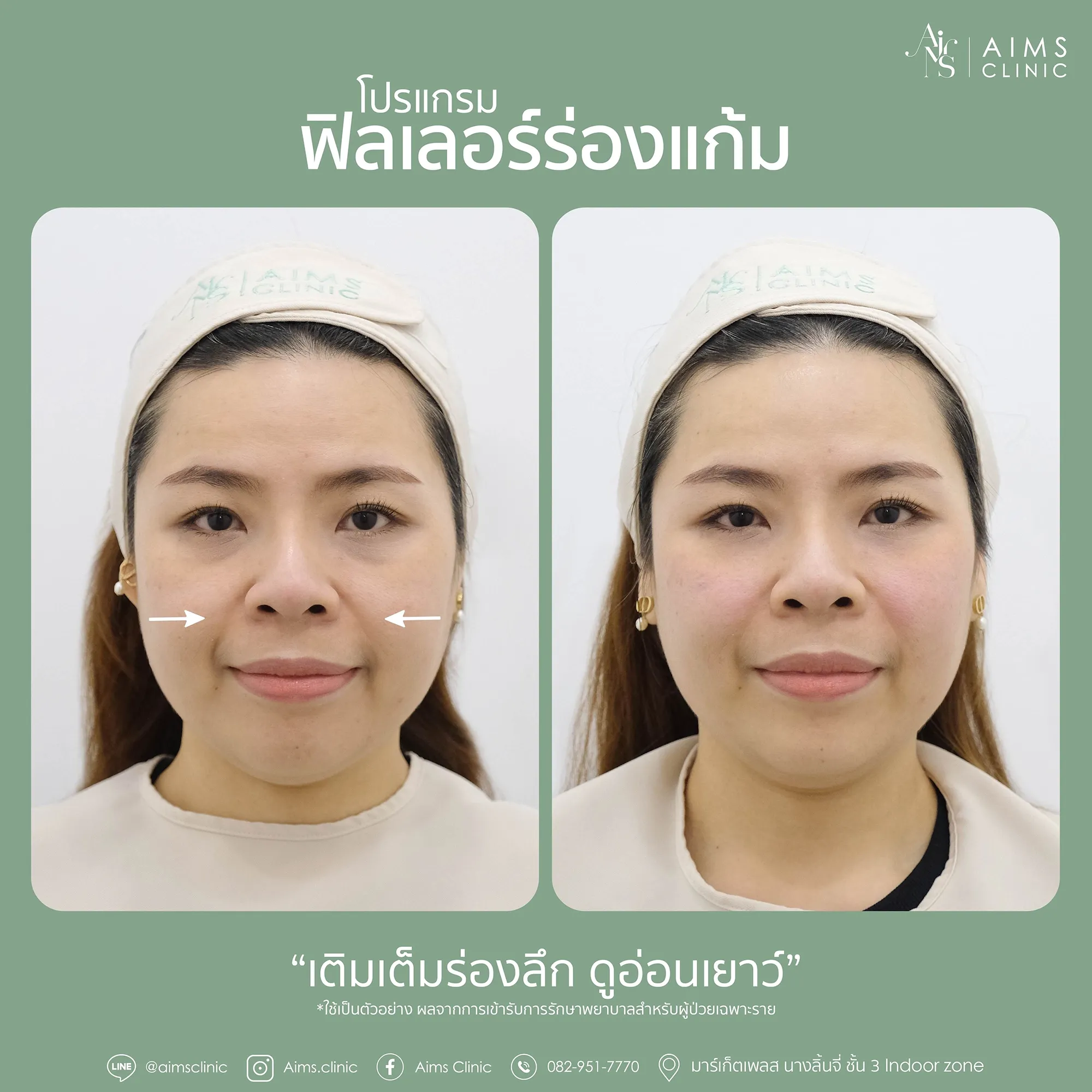Before_After_Filler-1-07.webp