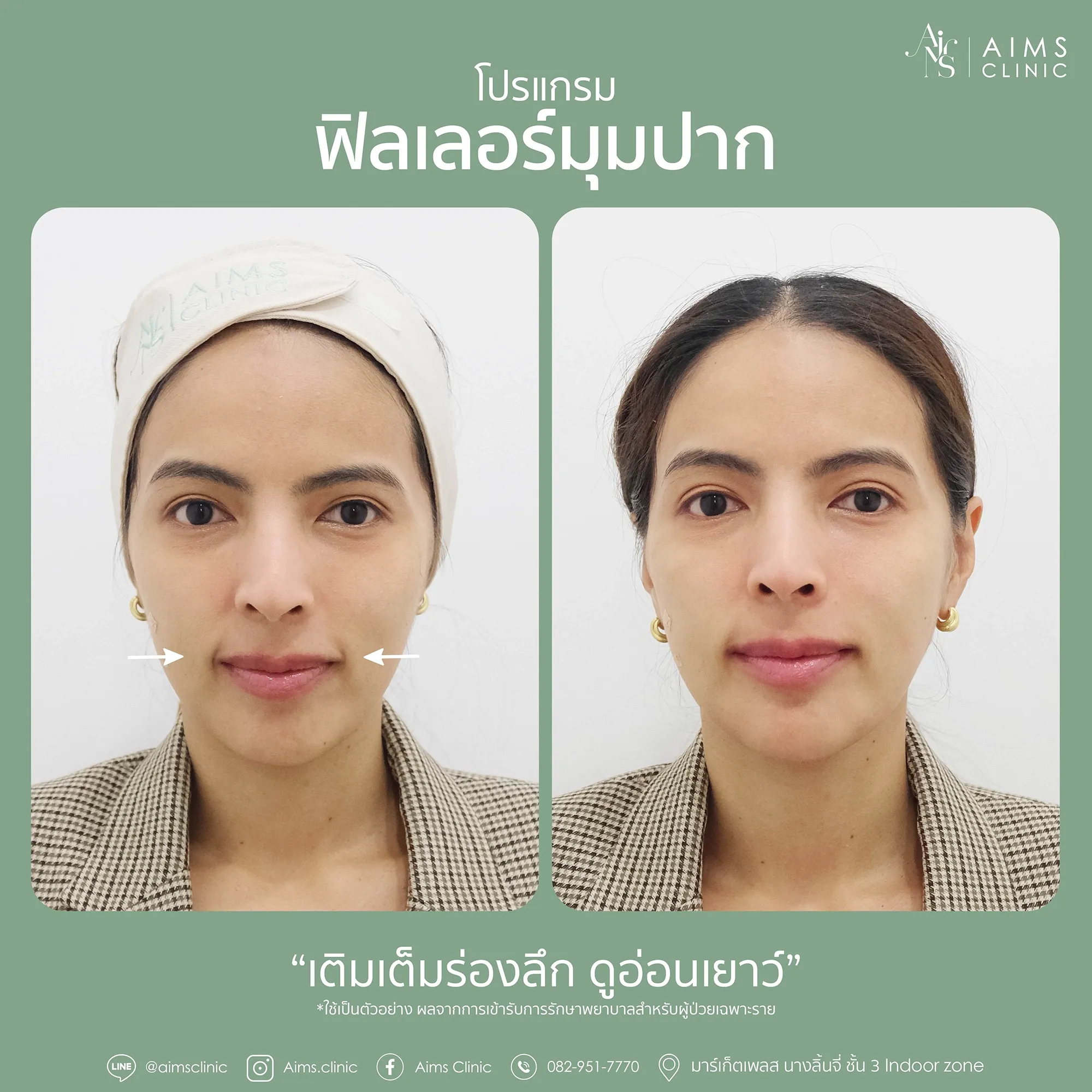 Before_After_Filler-1-08.webp