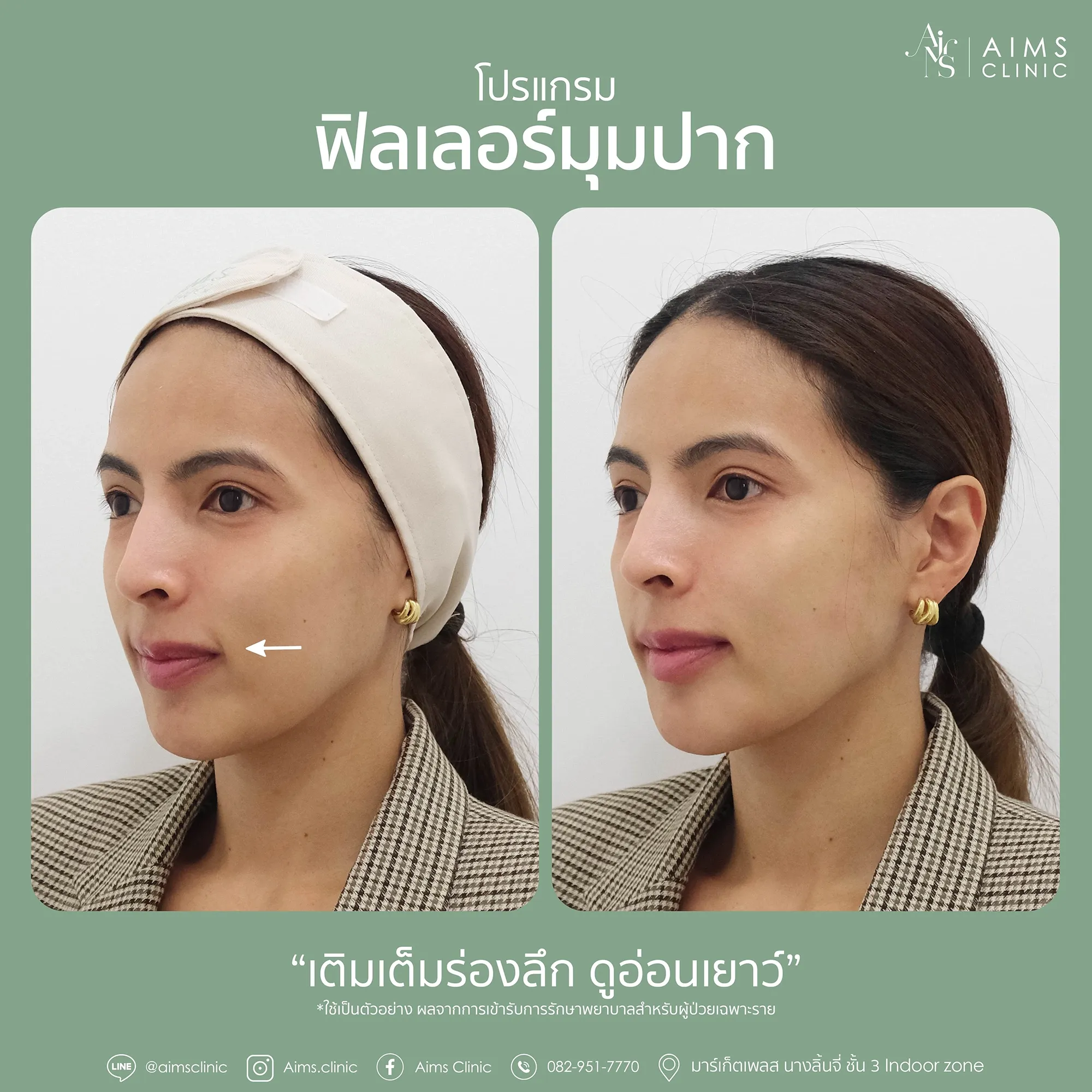 Before_After_Filler-1-09.webp