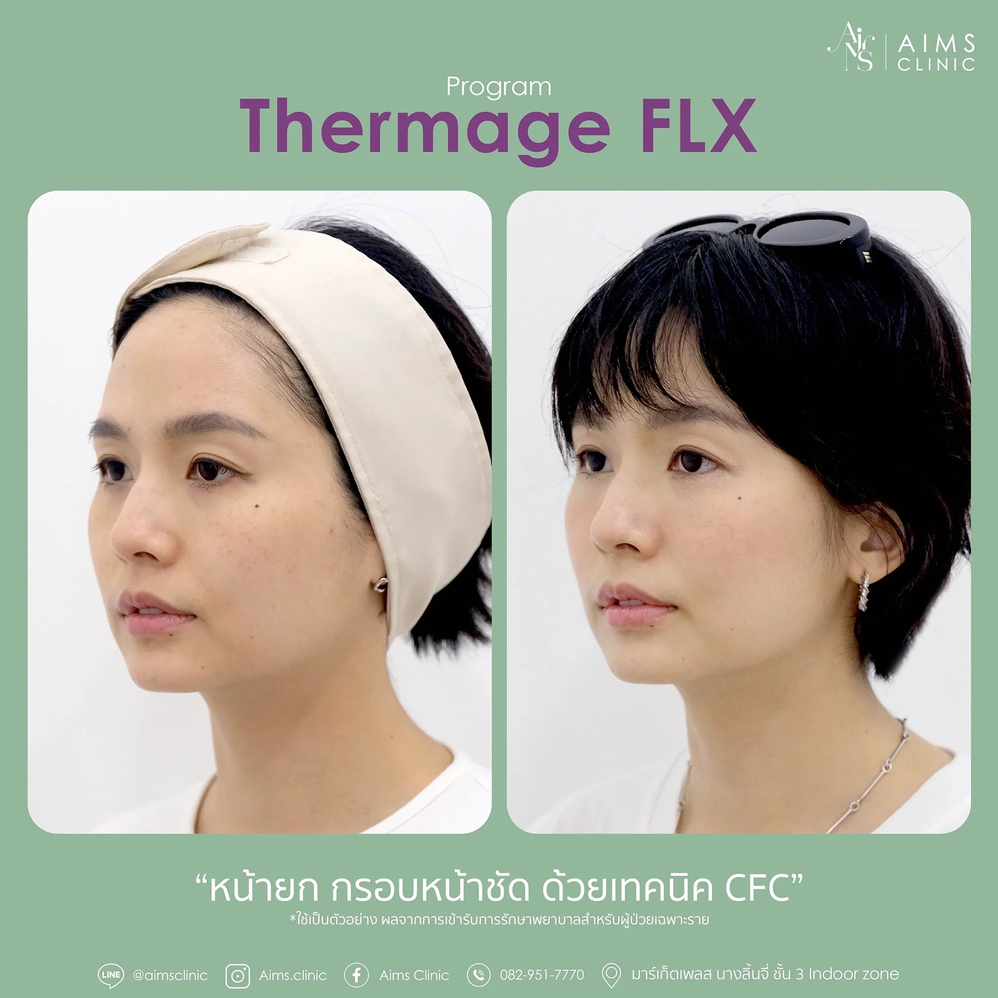 Before_After_thermage-1-01.webp