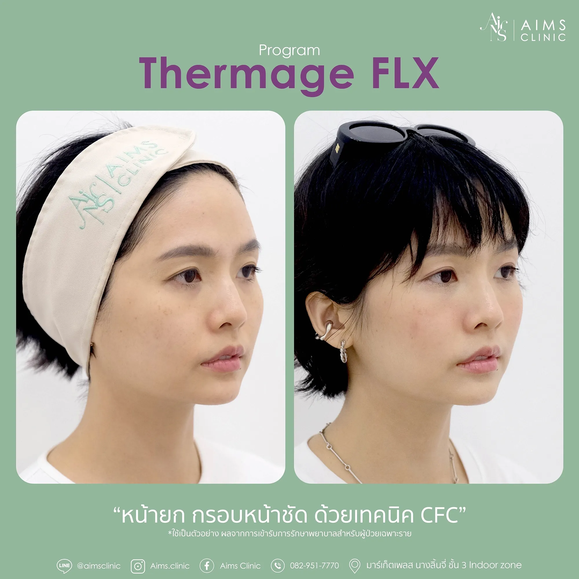 Before_After_thermage-1-02.webp