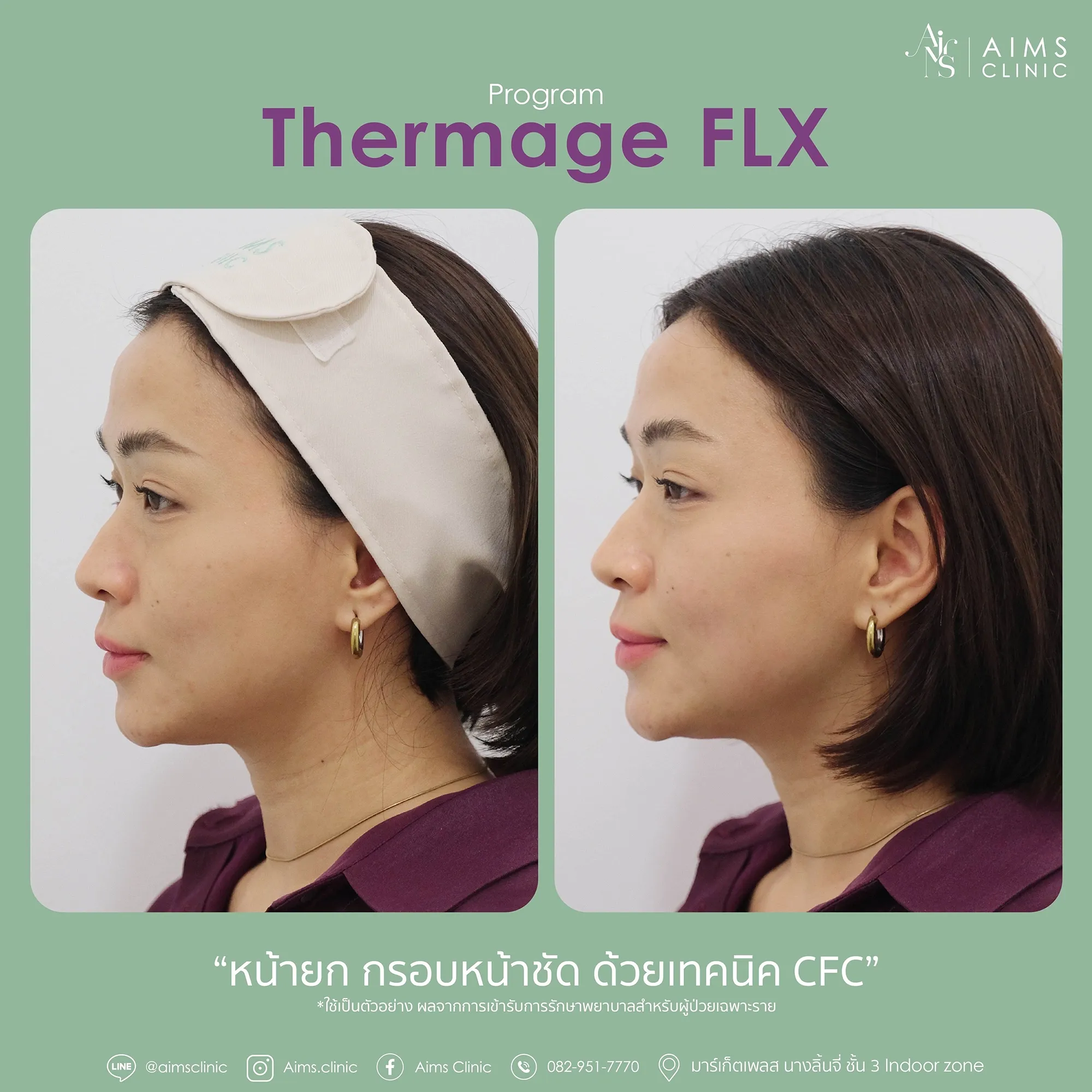 Before_After_thermage-1-03.webp