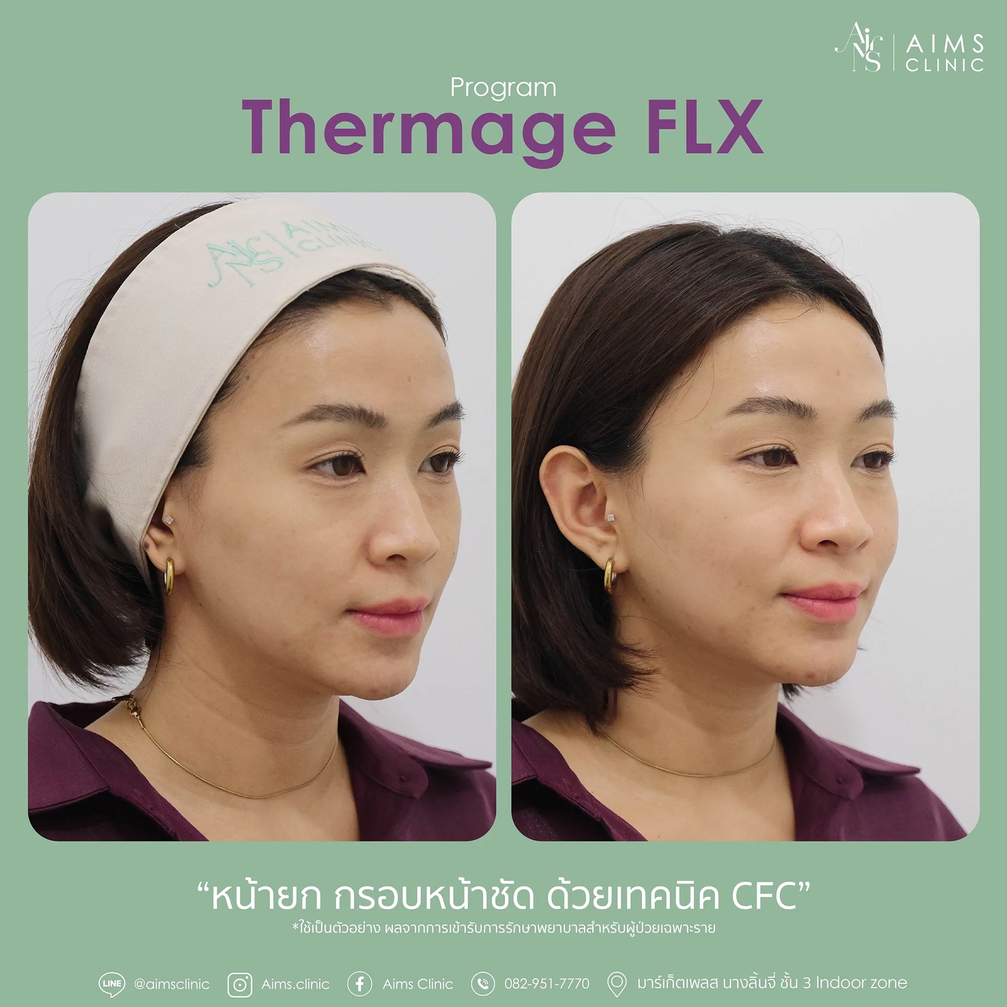 Before_After_thermage-1-04.webp
