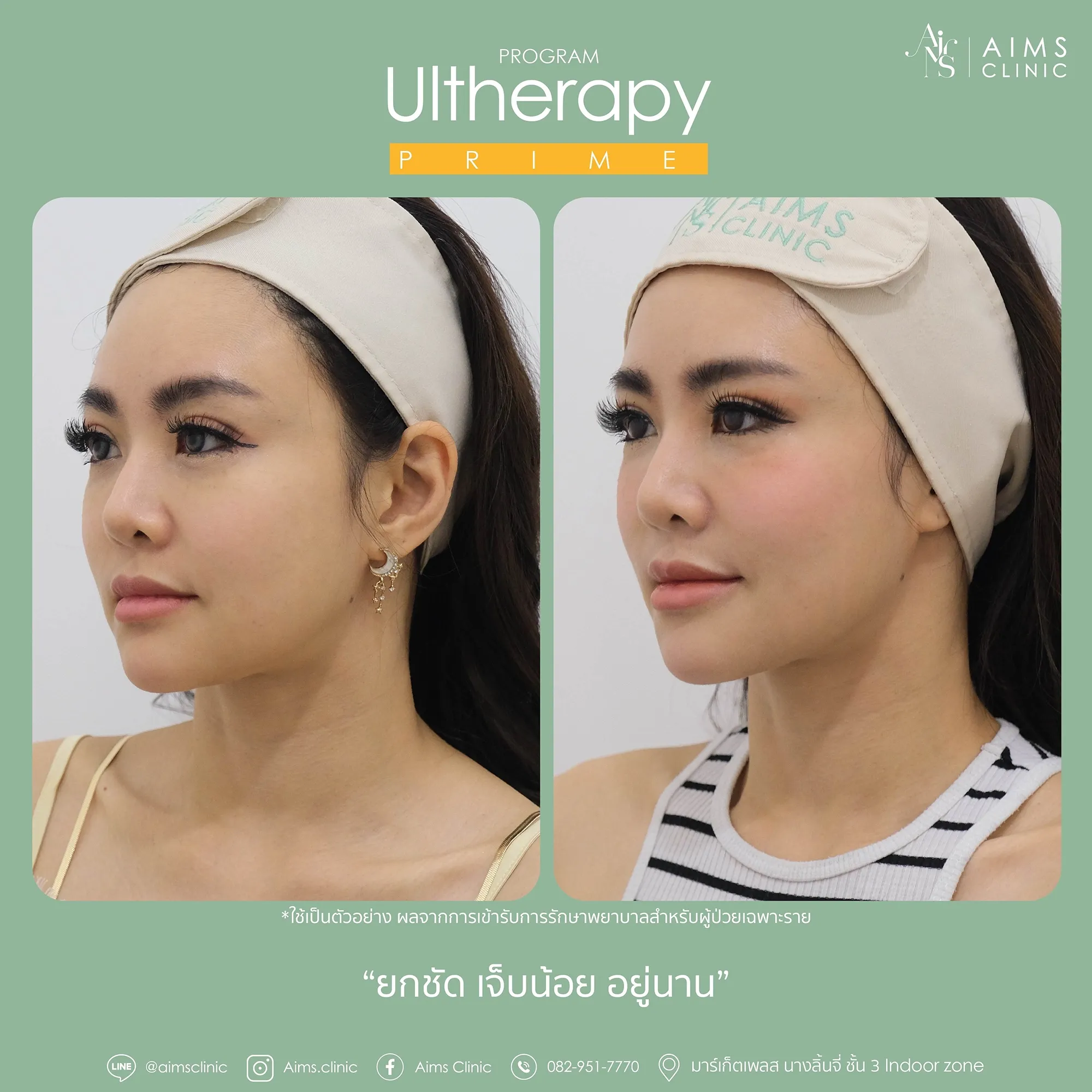 before_After_Ulthera-16.webp