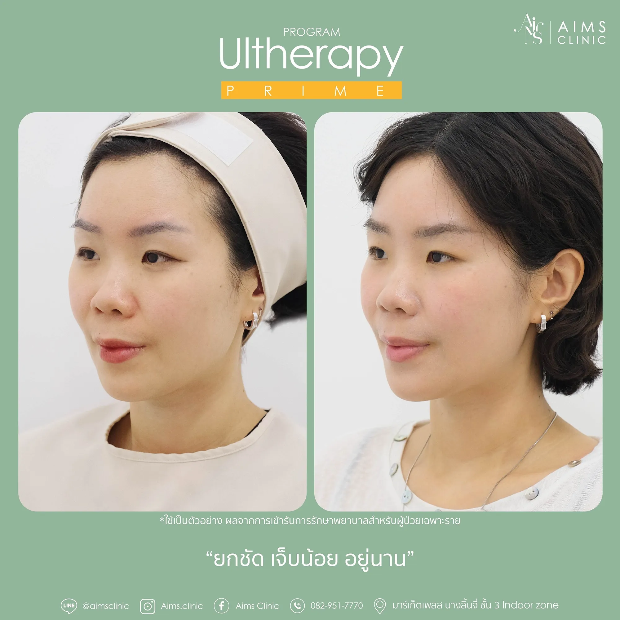 before_After_Ulthera-17.webp
