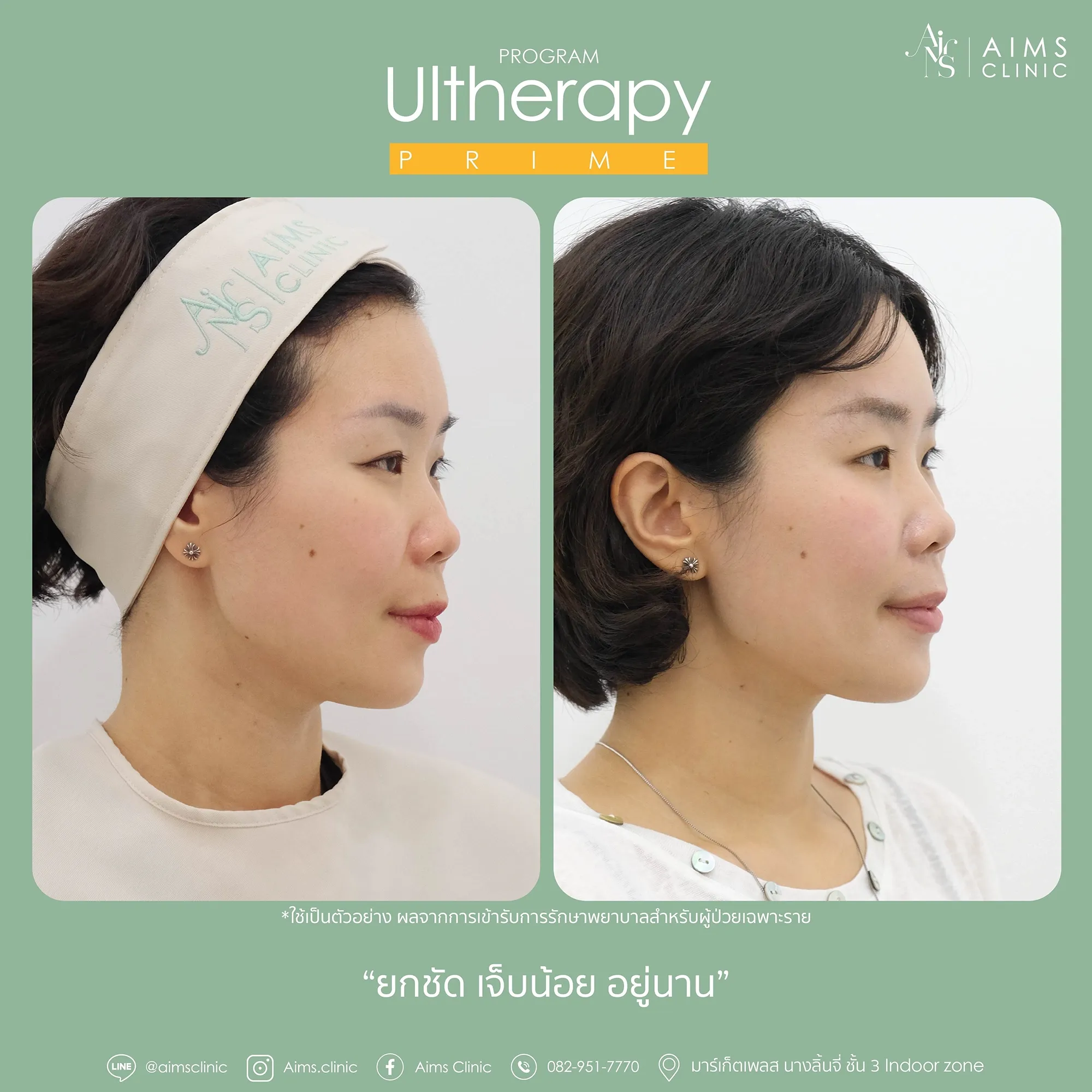 before_After_Ulthera-18.webp