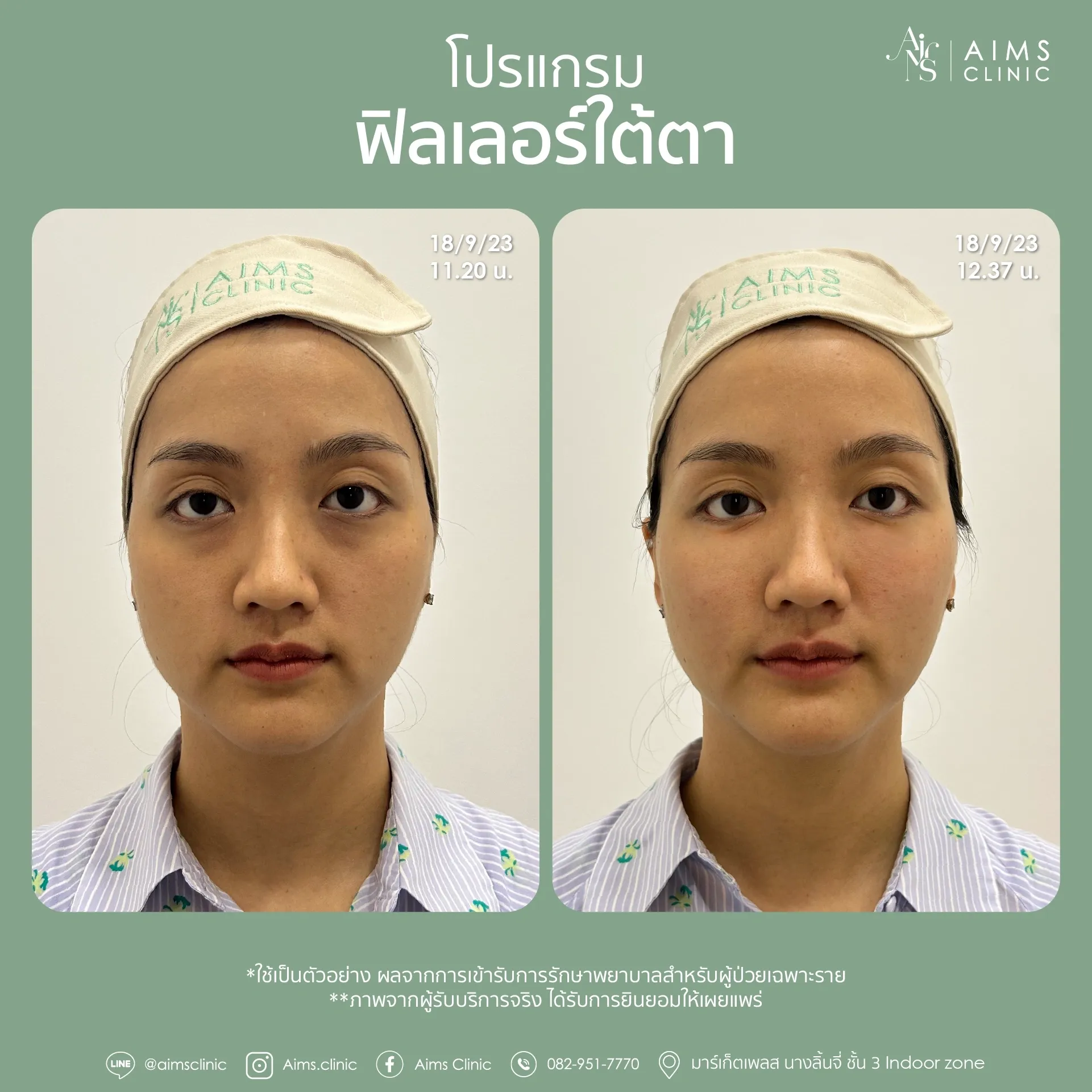 Before_After_Filler -01.webp