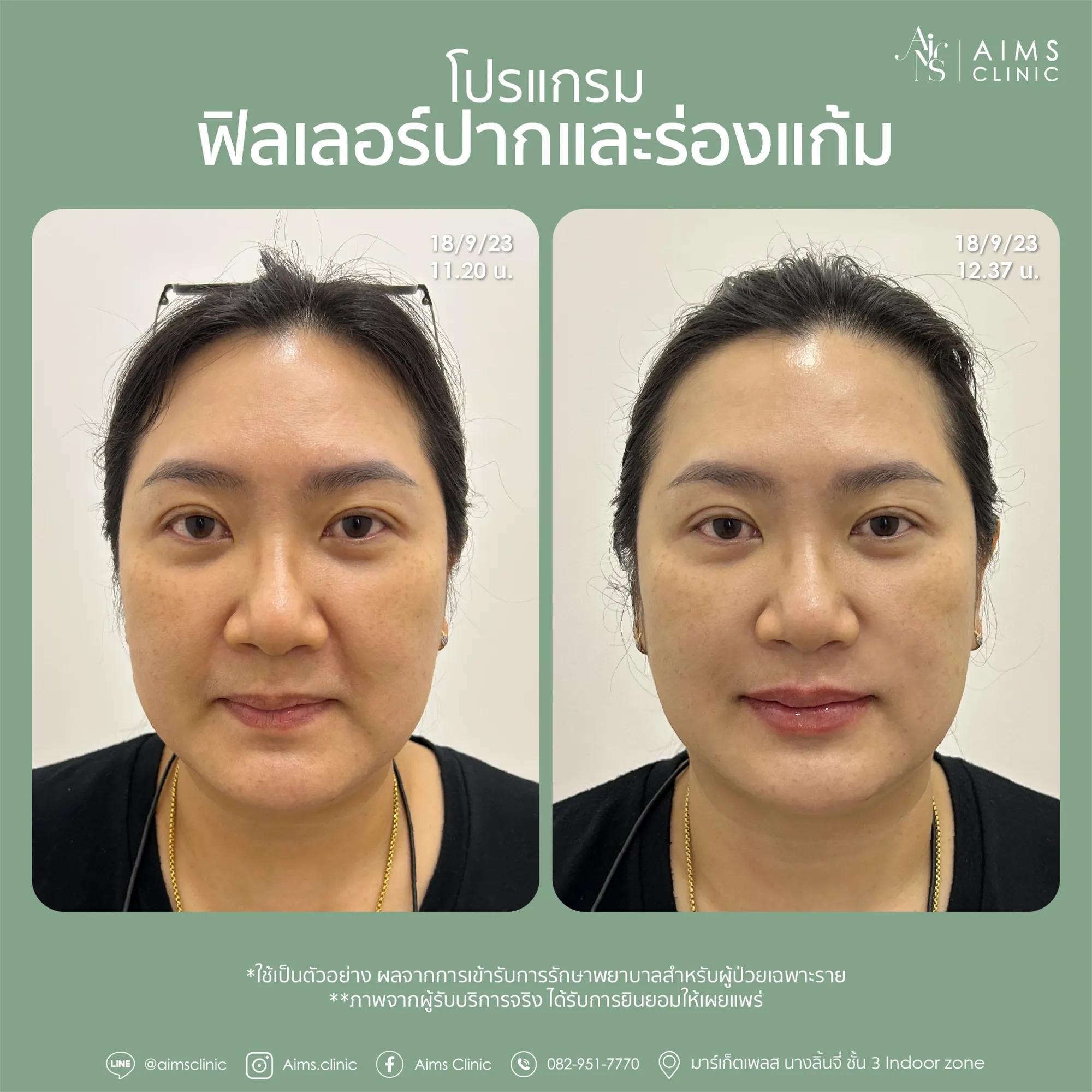 Before_After_Filler -02.webp