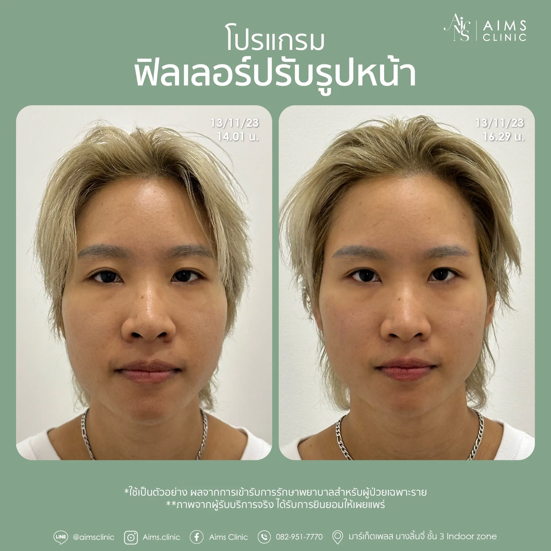 Before_After_Filler -03.webp