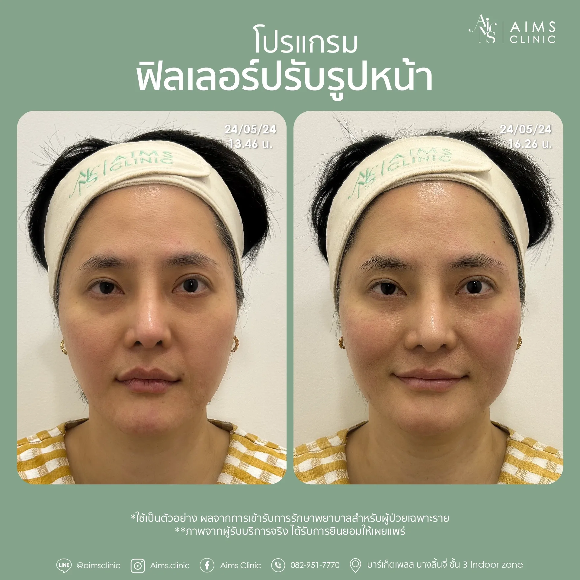 Before_After_Filler -04.webp