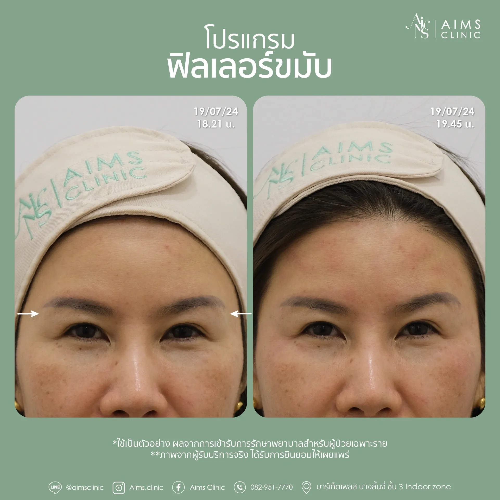 Before_After_Filler -06.webp