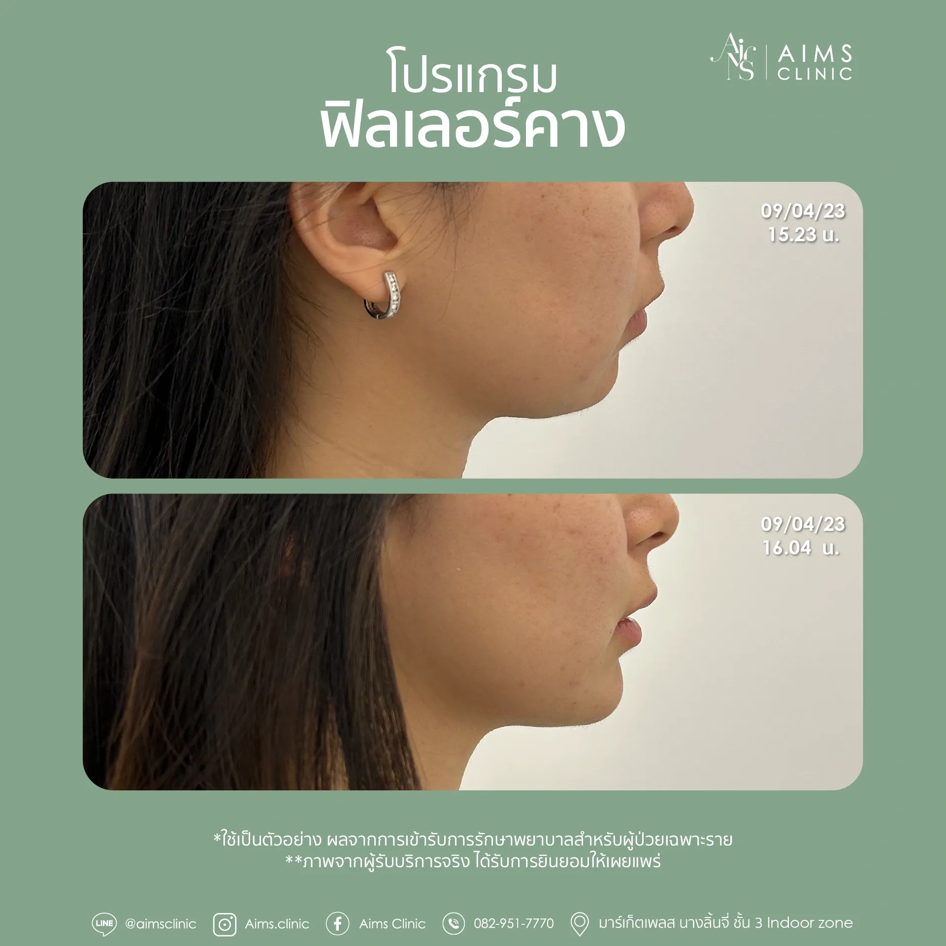 Before_After_Filler -11.webp