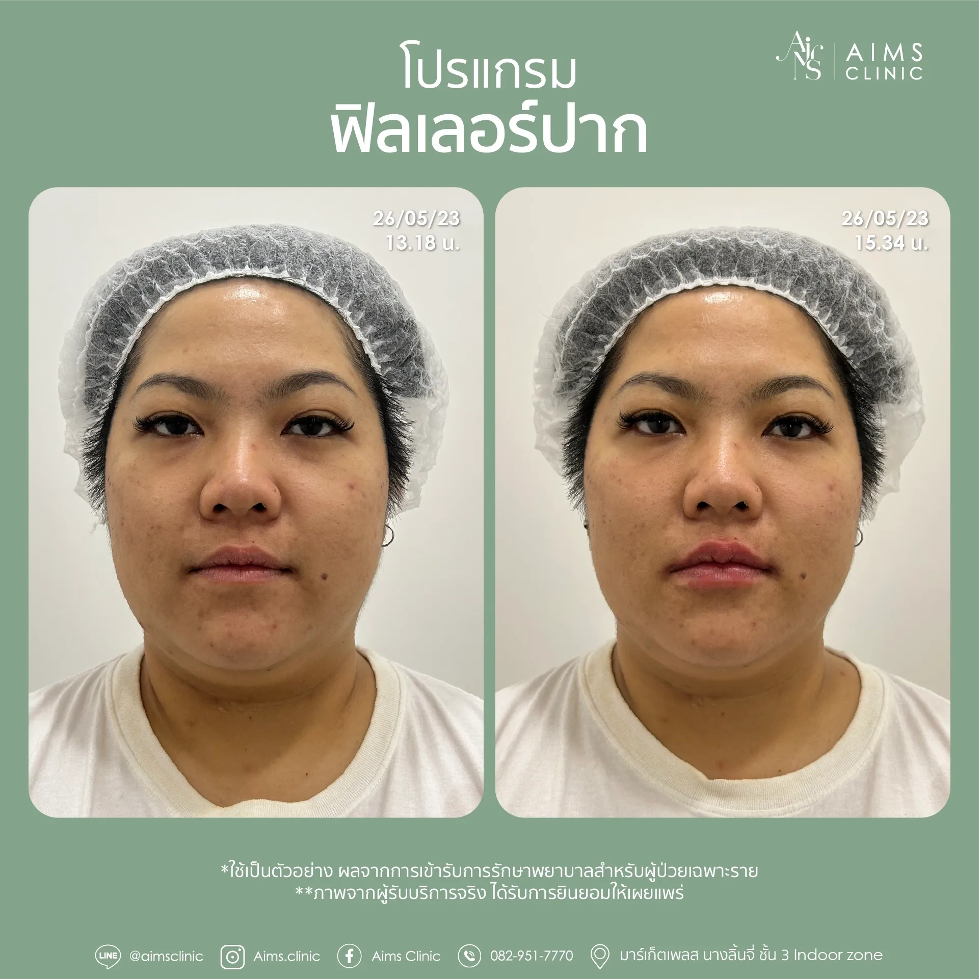 Before_After_Filler -13.webp