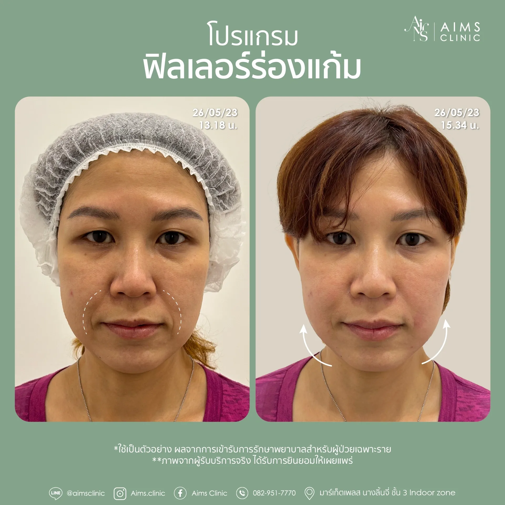 Before_After_Filler -14.webp