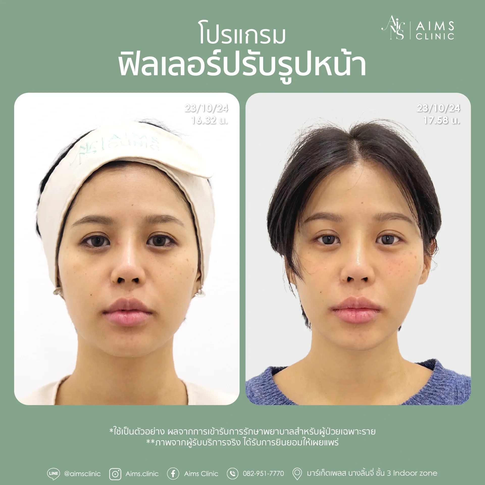 Before_After_Filler -15.webp