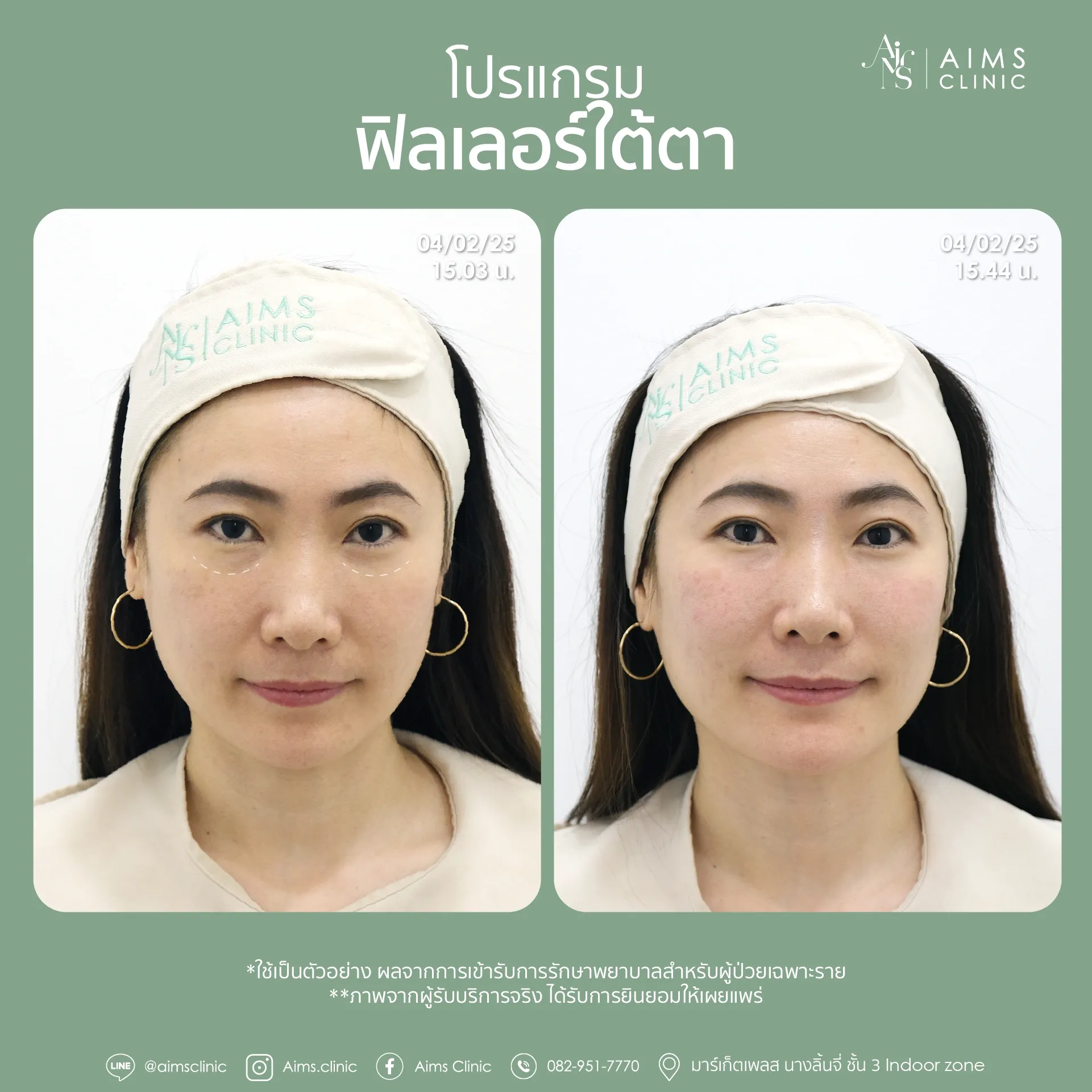 Before_After_Filler -16.webp