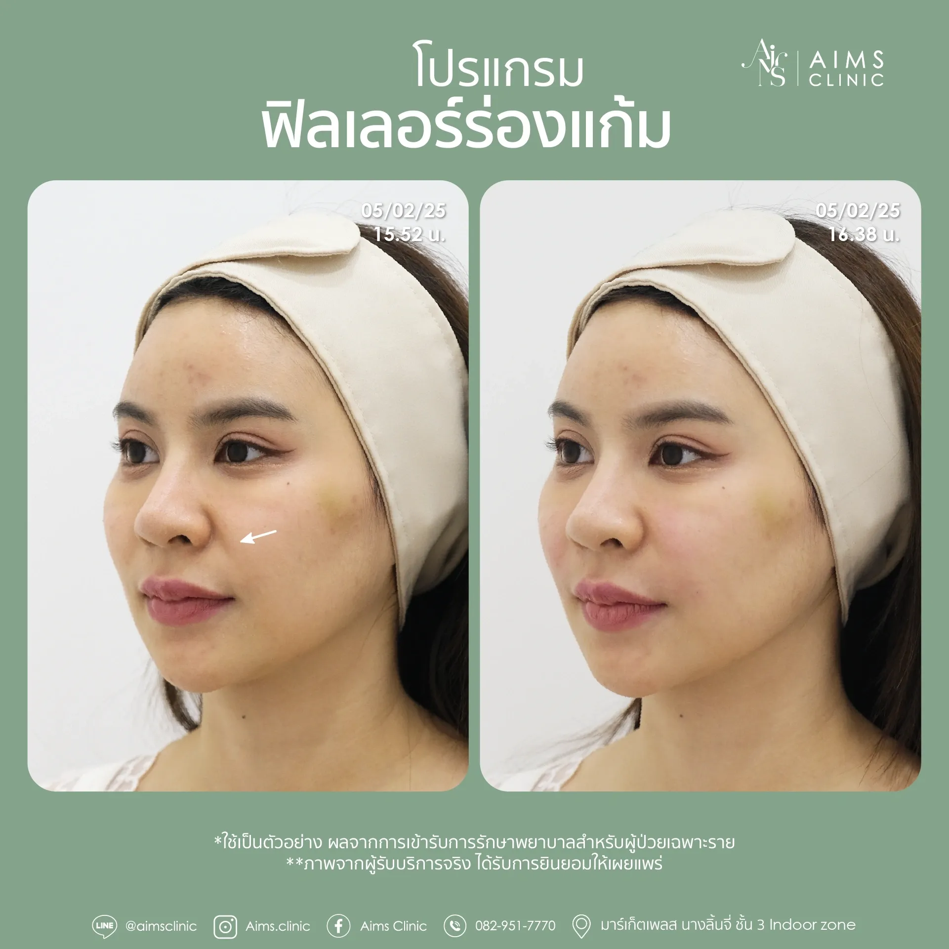 Before_After_Filler -17.webp