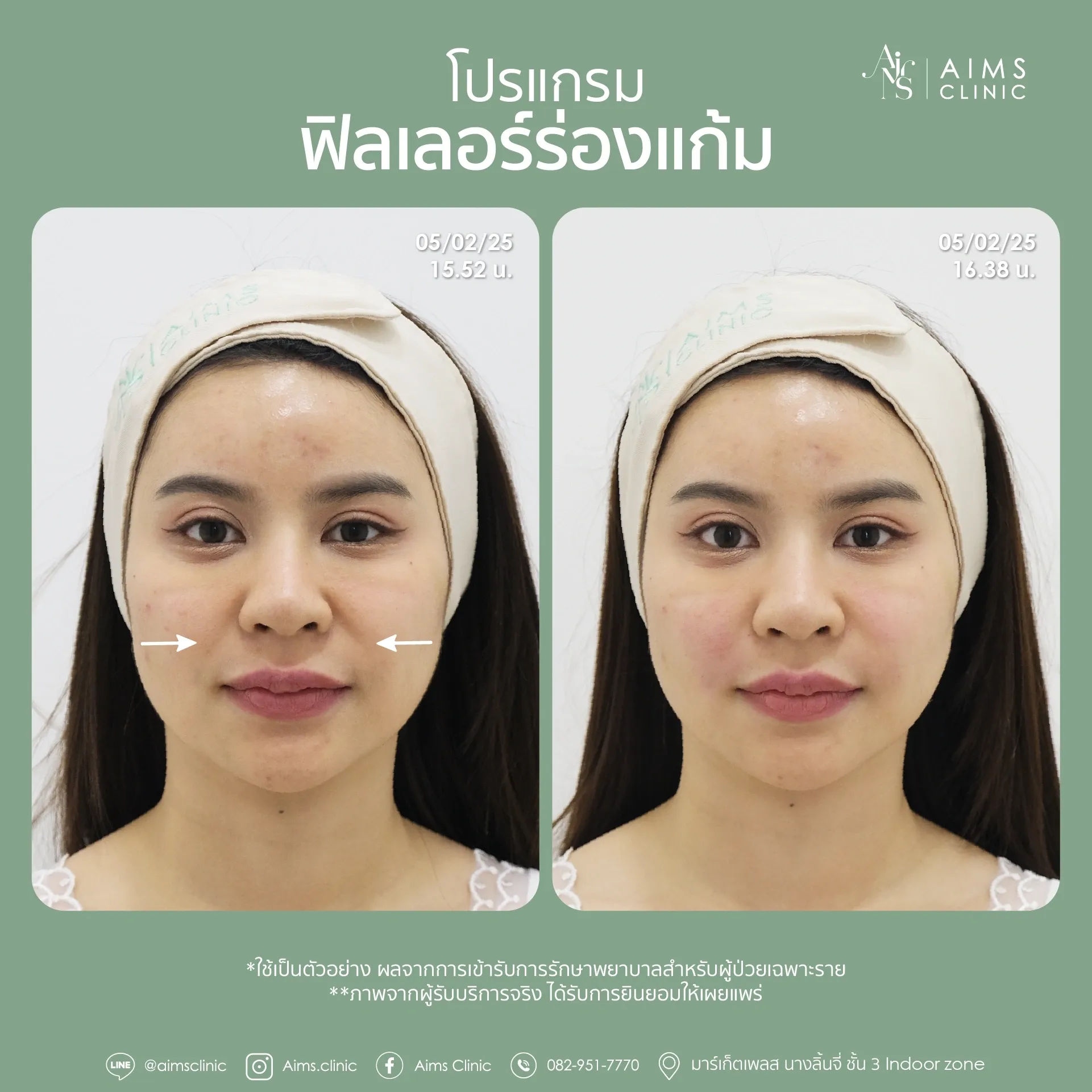 Before_After_Filler -18.webp