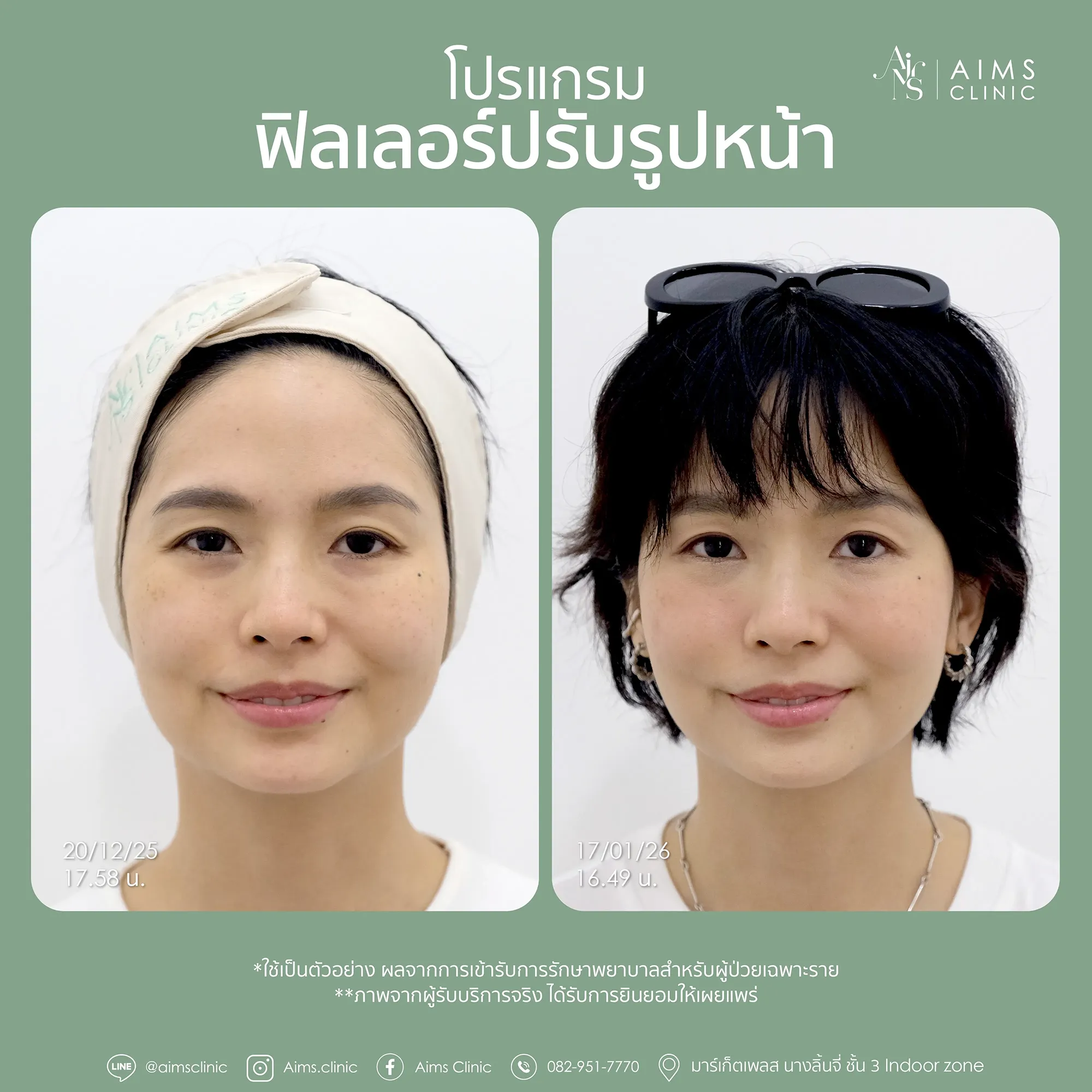Before_After_Filler-1-02.webp