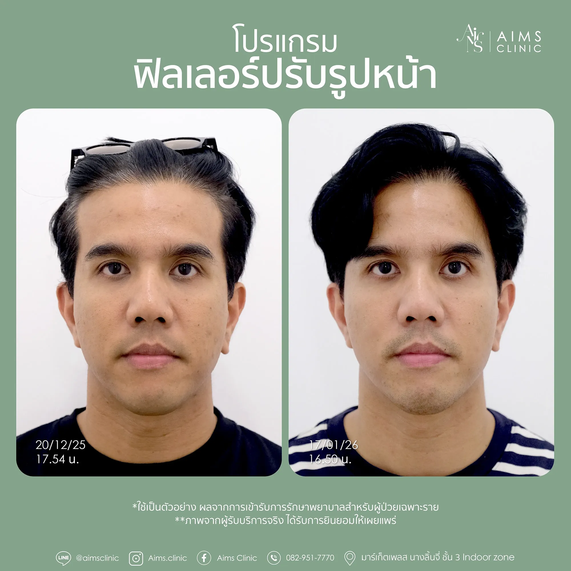 Before_After_Filler-1-03.webp