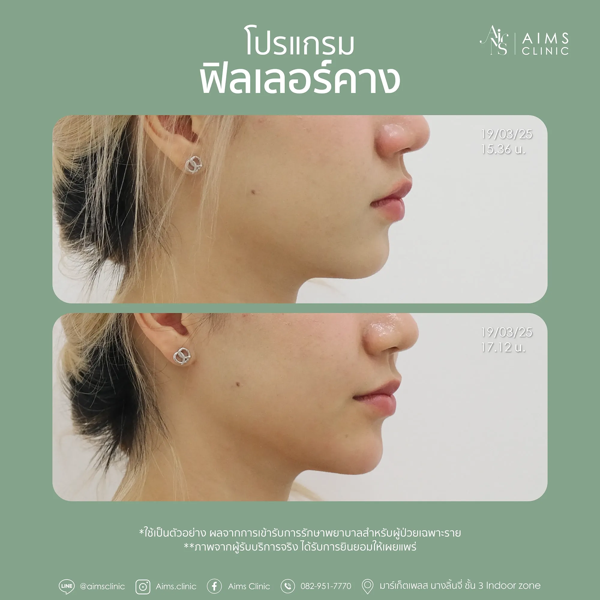 Before_After_Filler-1-04.webp