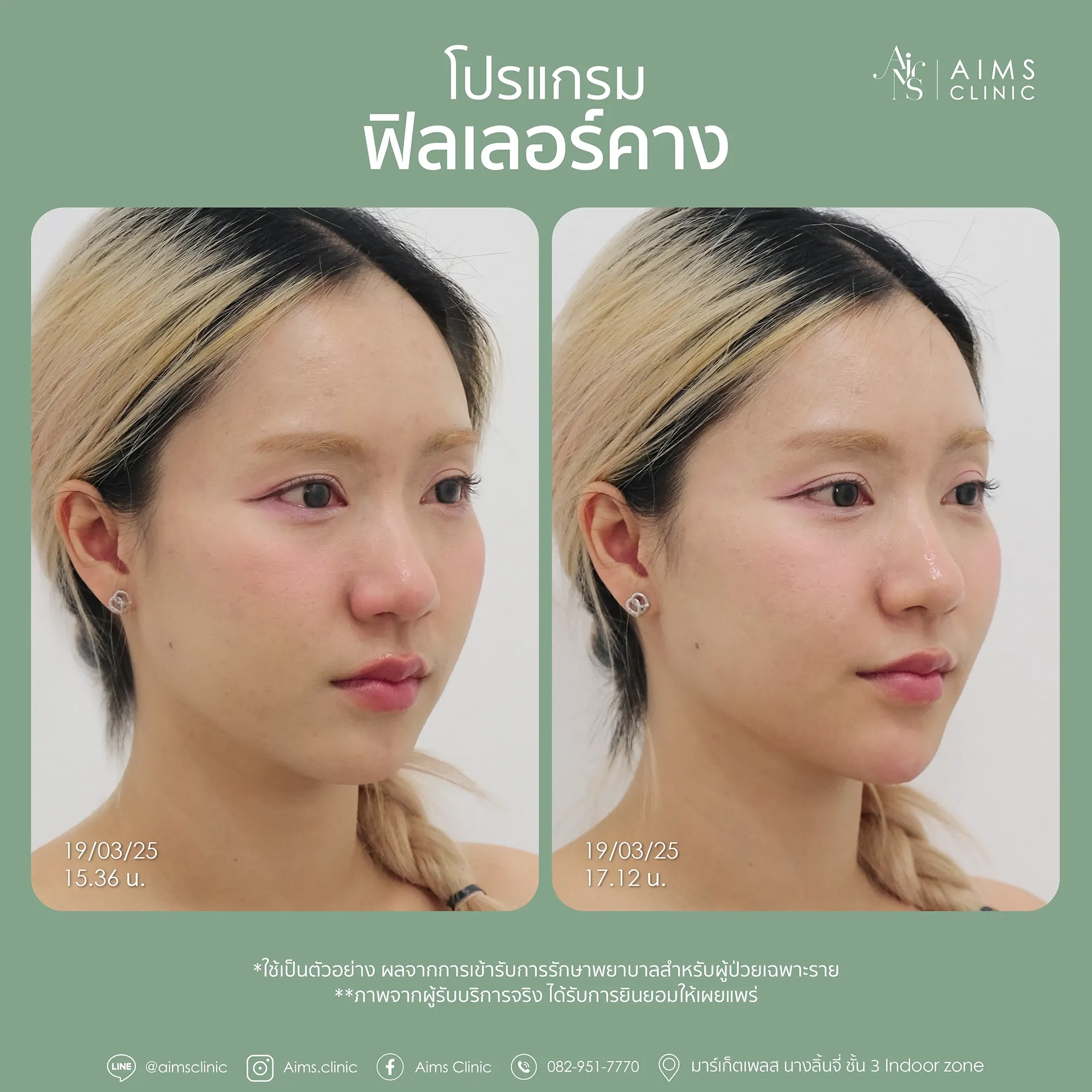 Before_After_Filler-1-05.webp