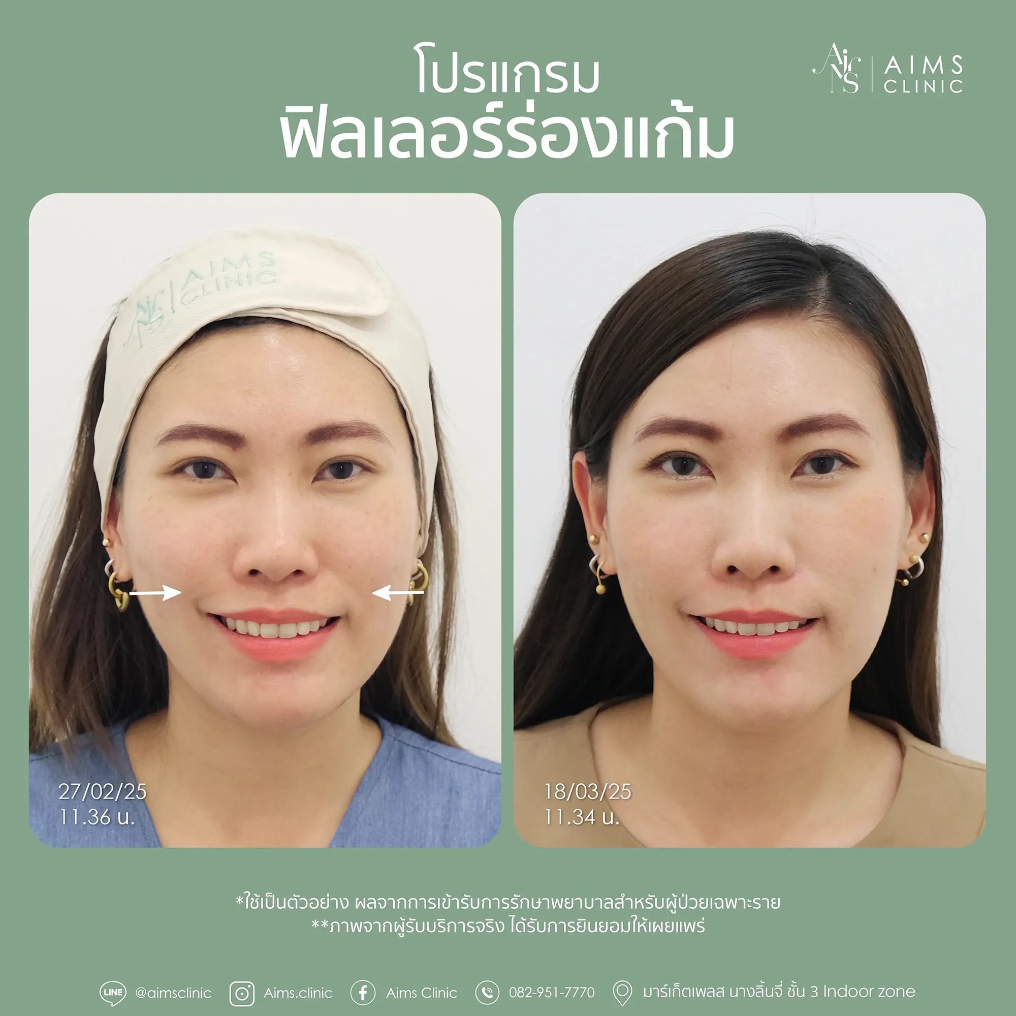 Before_After_Filler-1-06.webp