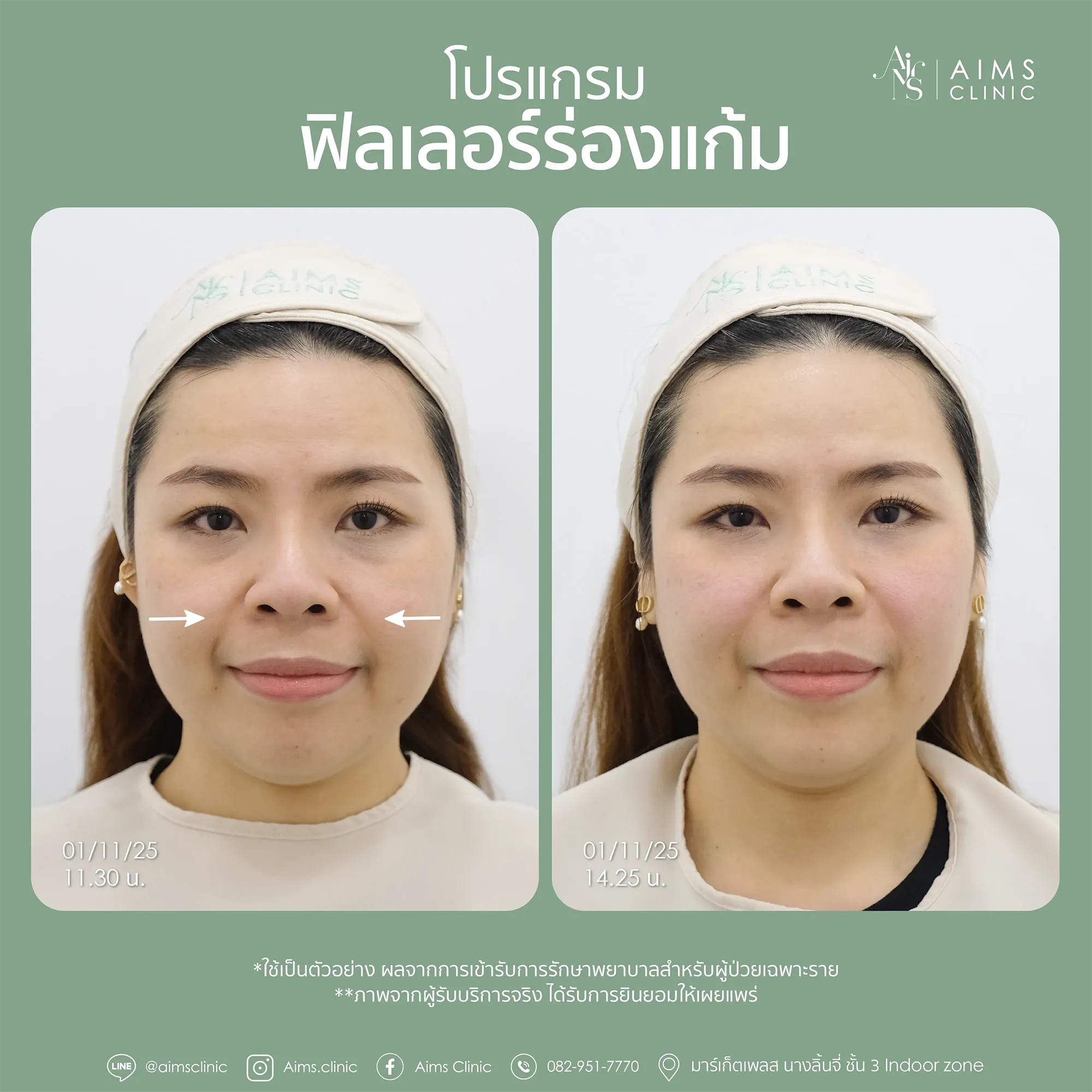 Before_After_Filler-1-07.webp