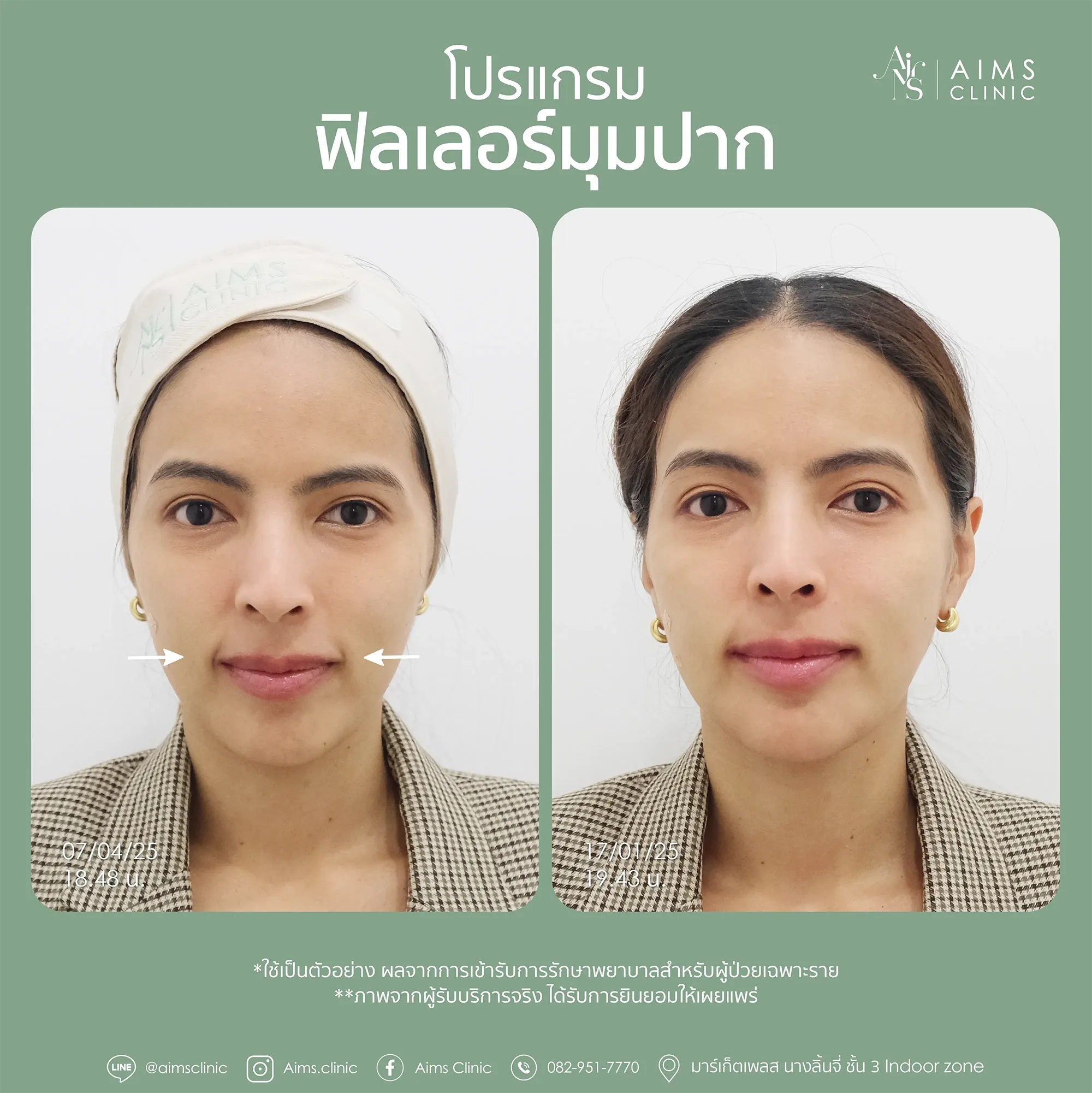 Before_After_Filler-1-08.webp