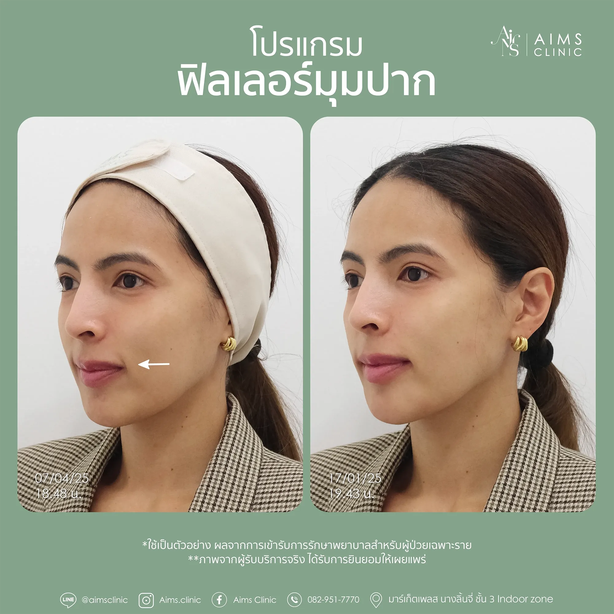 Before_After_Filler-1-09.webp