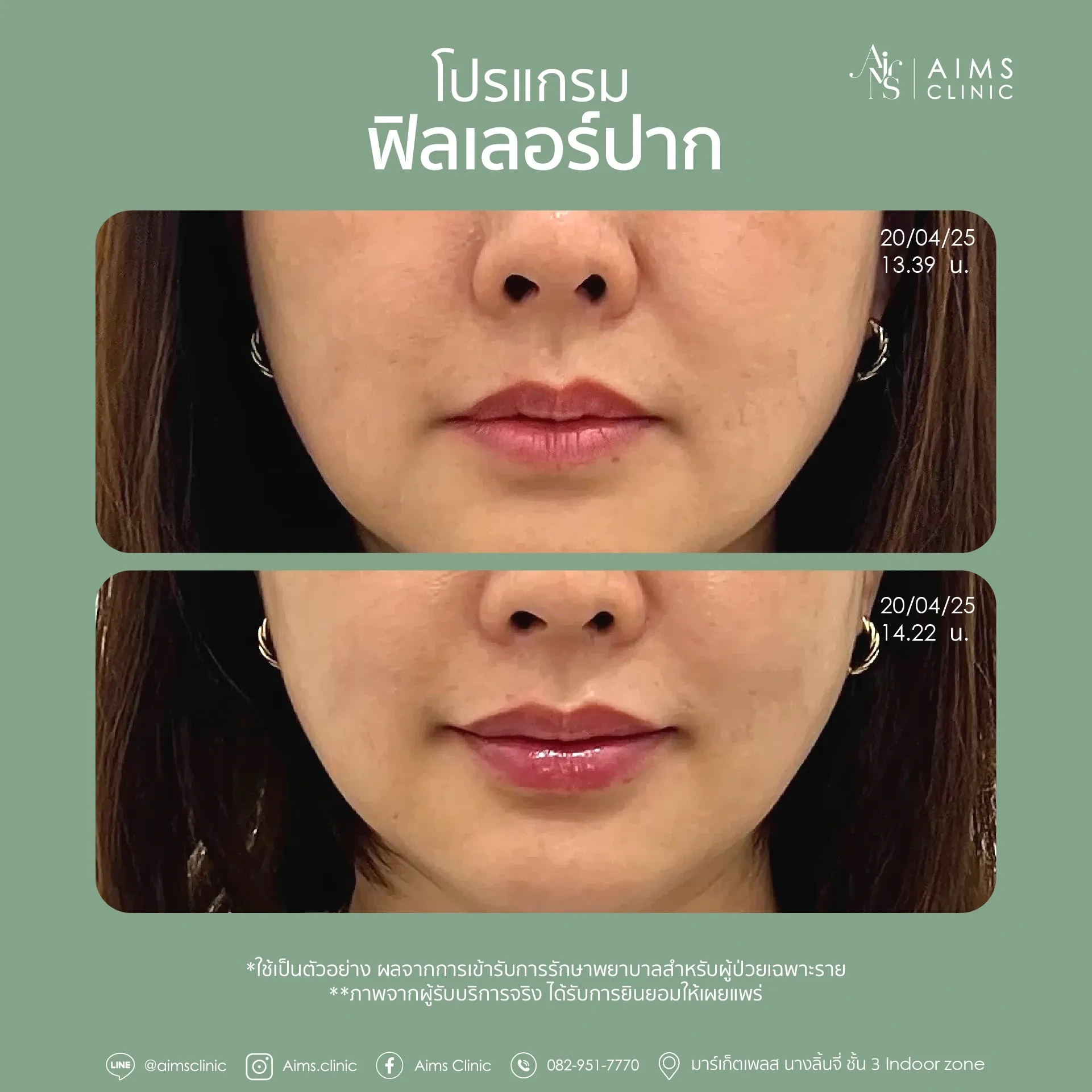 Before_After_Filler -20.webp