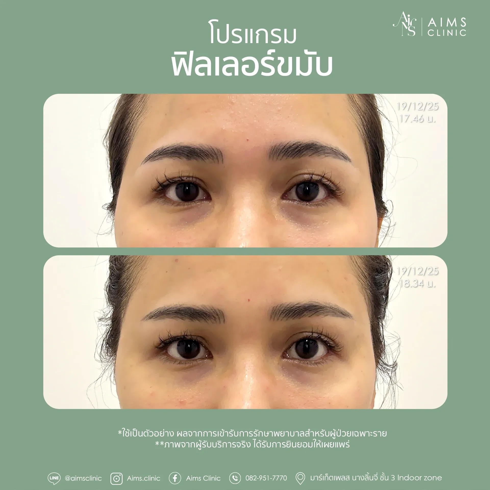 Before_After_Filler -23.webp