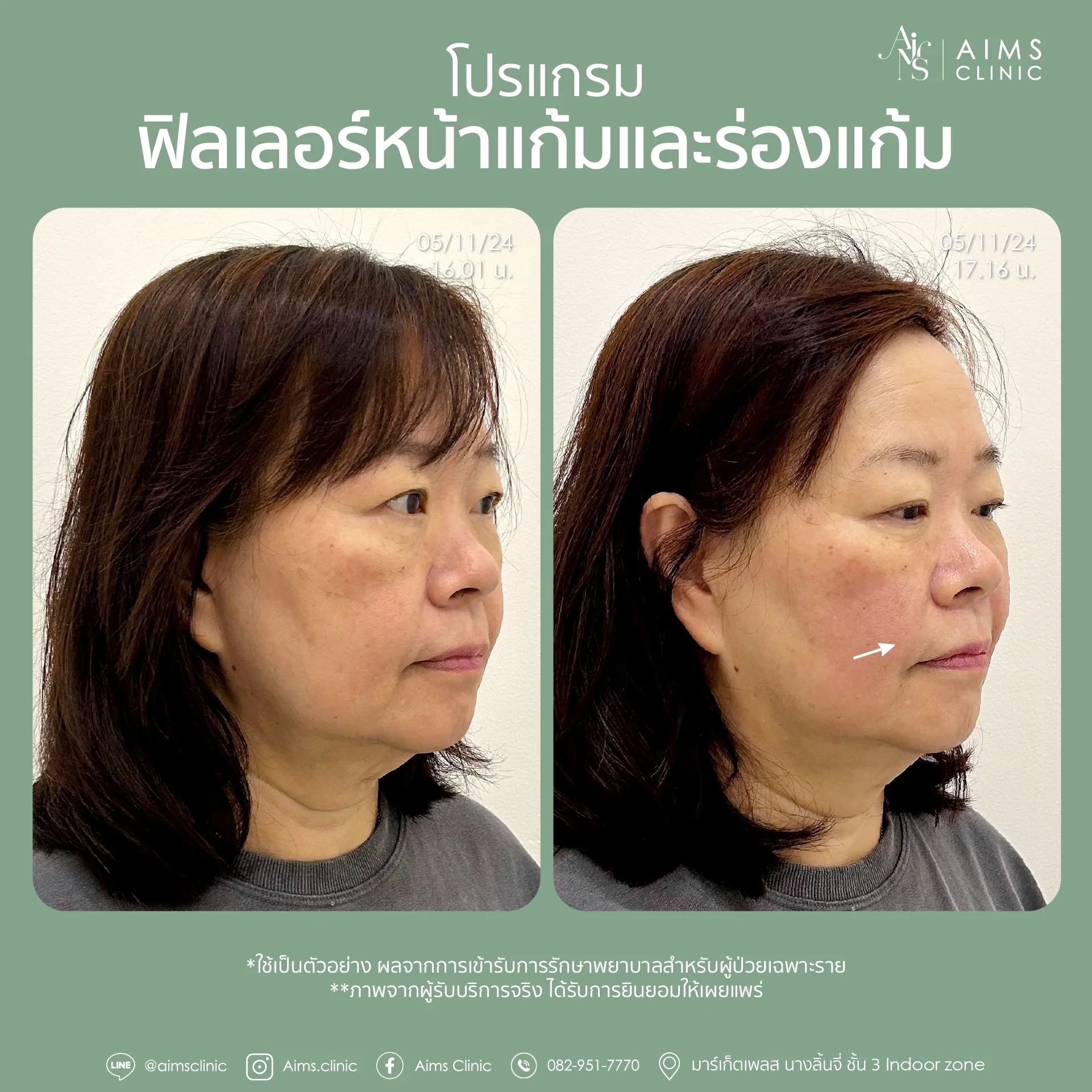 Before_After_Filler -24.webp