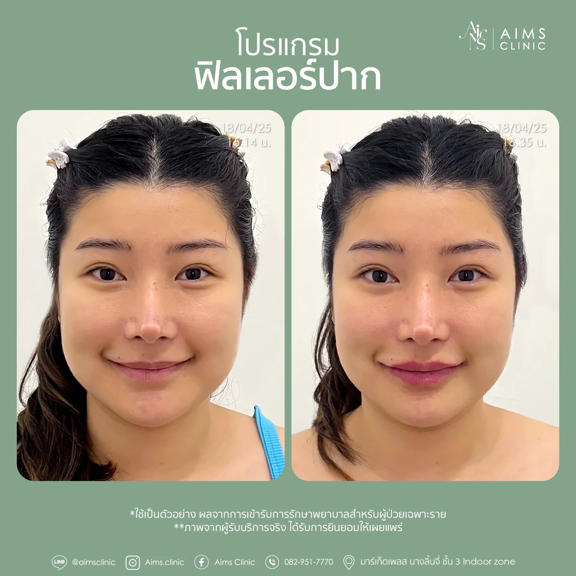 Before_After_Filler -27.webp