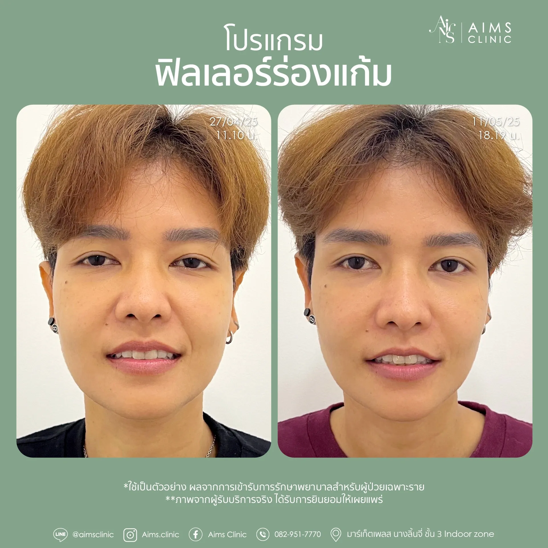 Before_After_Filler -31.webp