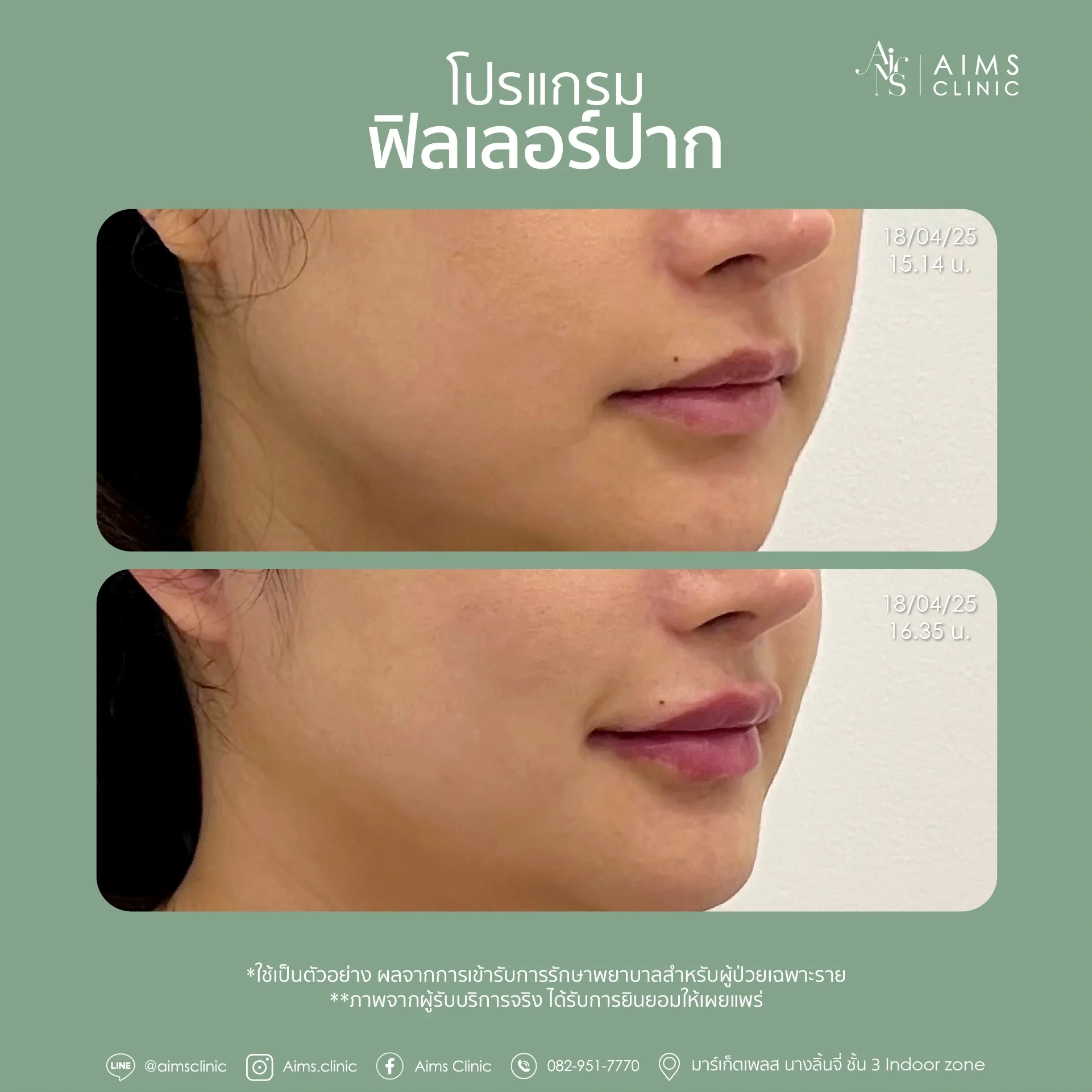 Before_After_Filler -32.webp