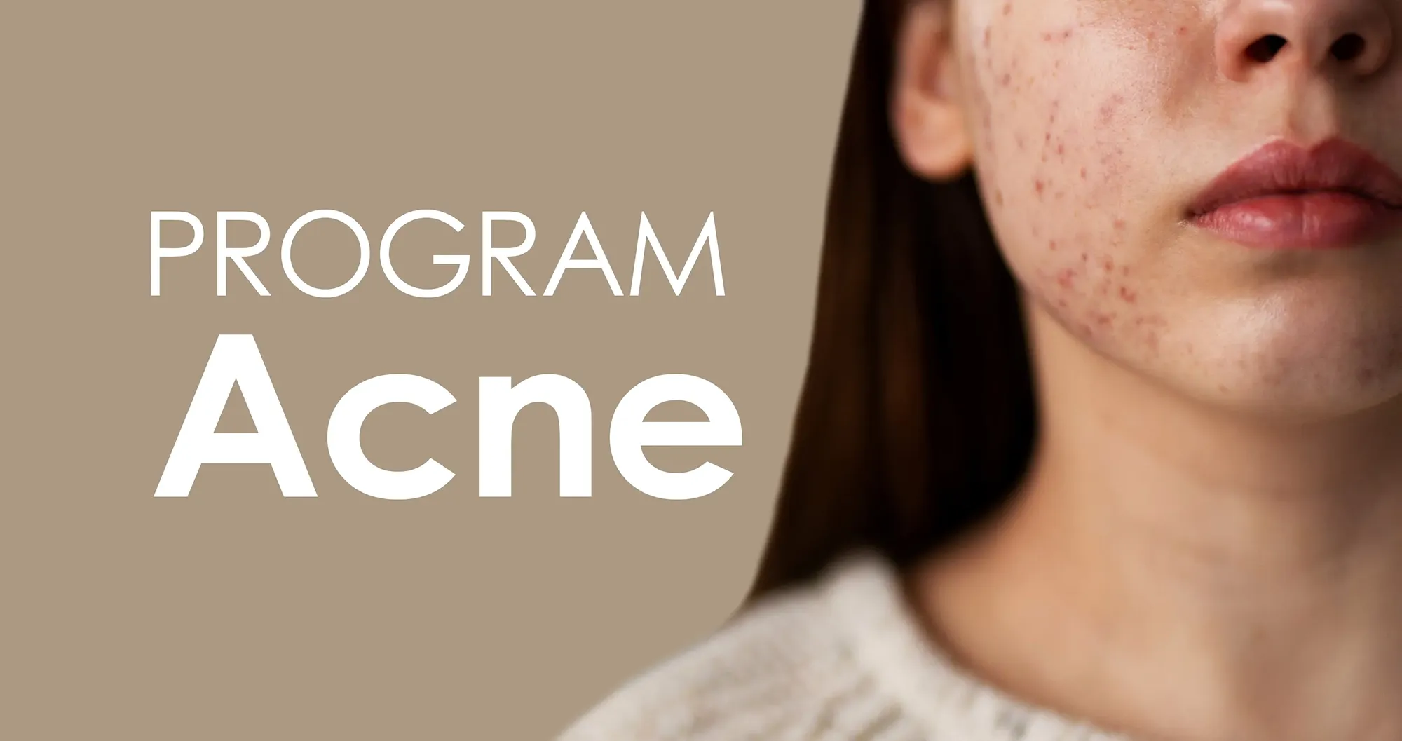 acne.webp
