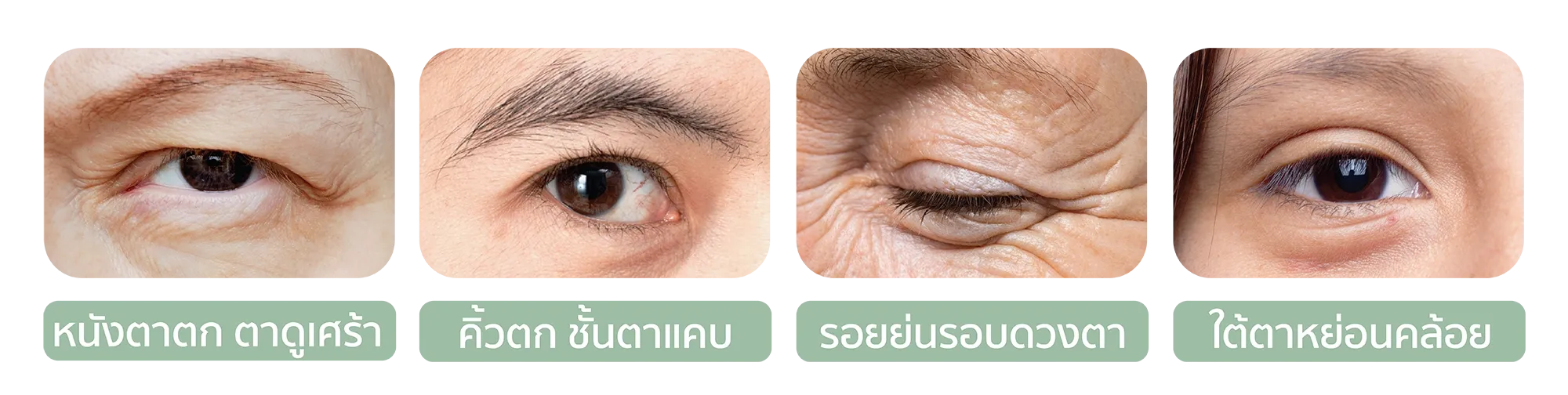 Thermage eye_sale page-02.webp