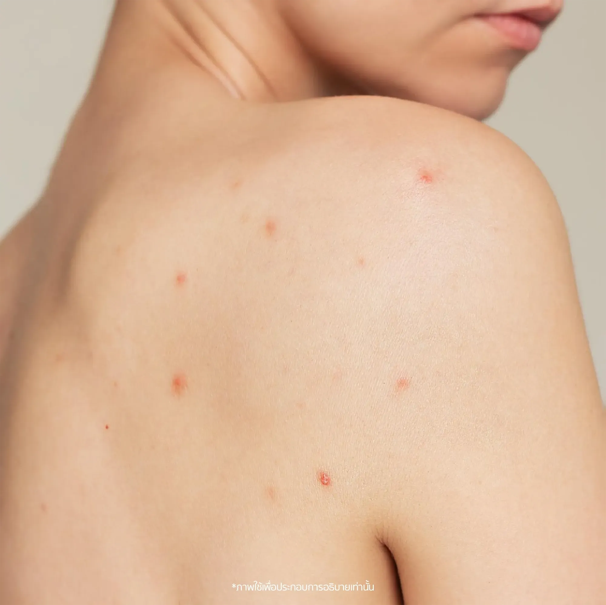 acne-02.webp