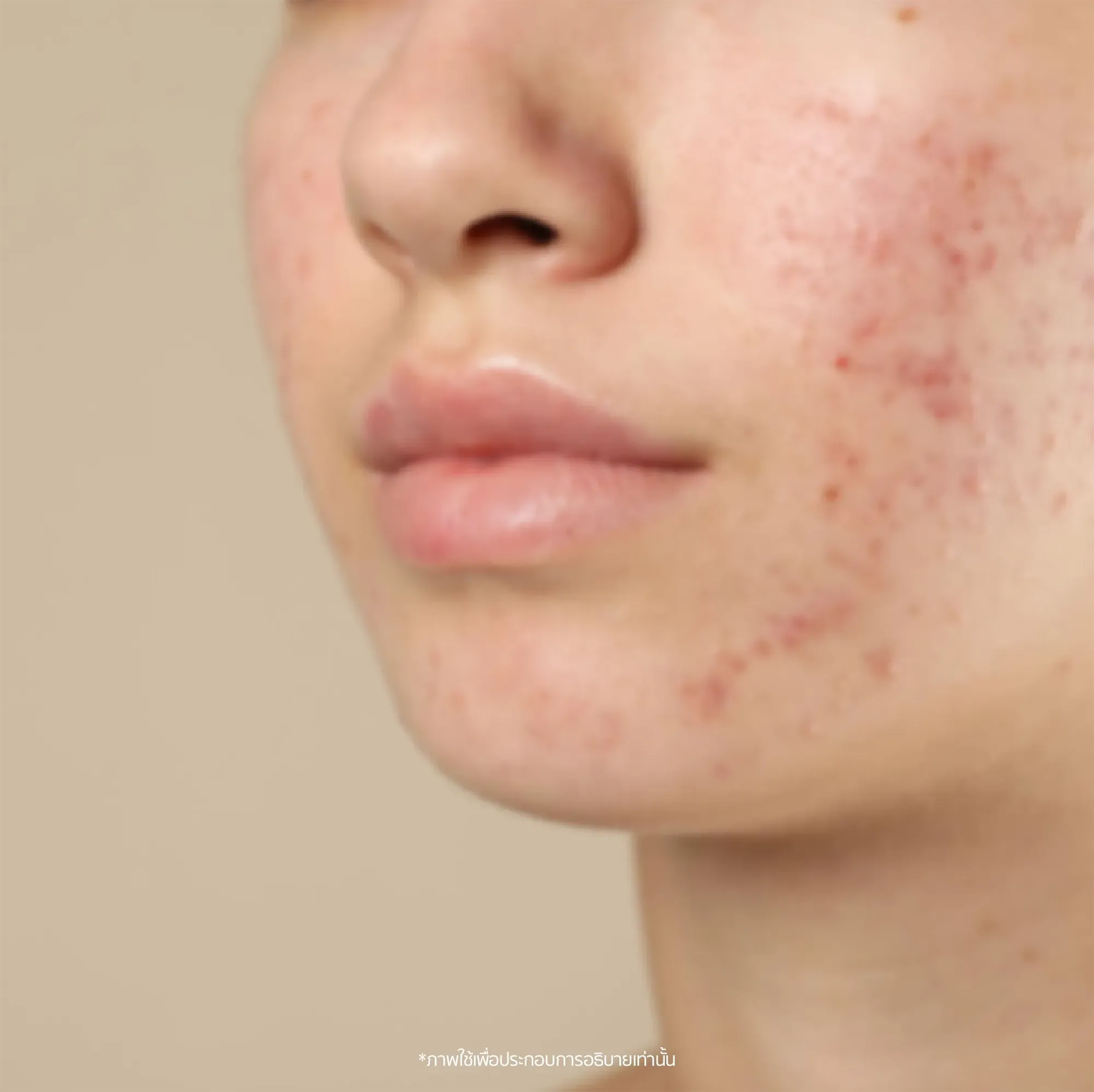 acne-03.webp