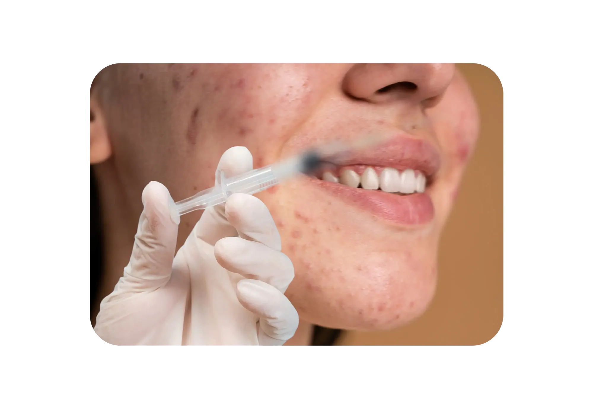 acne.webp